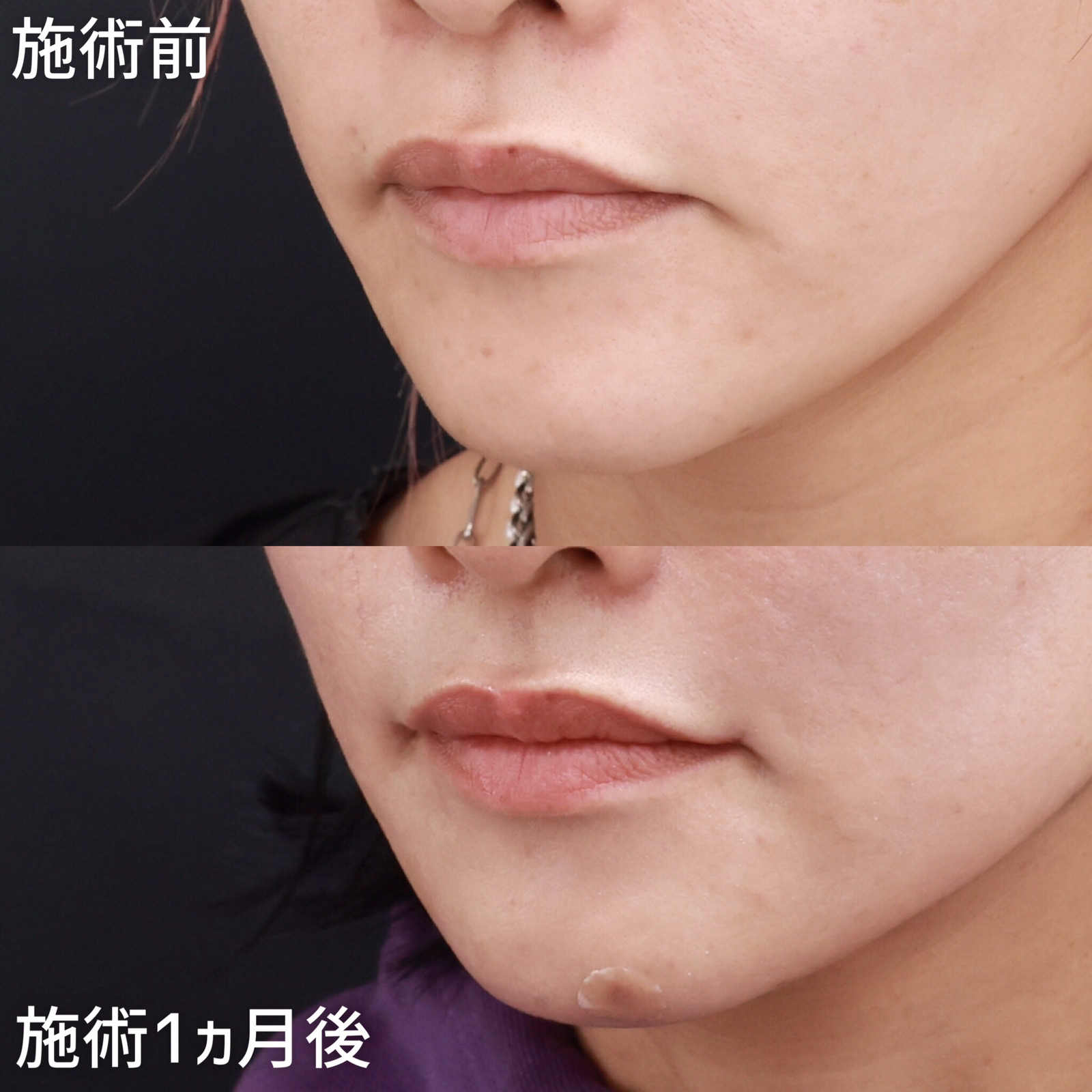 口角挙上・リフト（マイクロ切開法・内側法/口内法）の症例写真 施術前後 