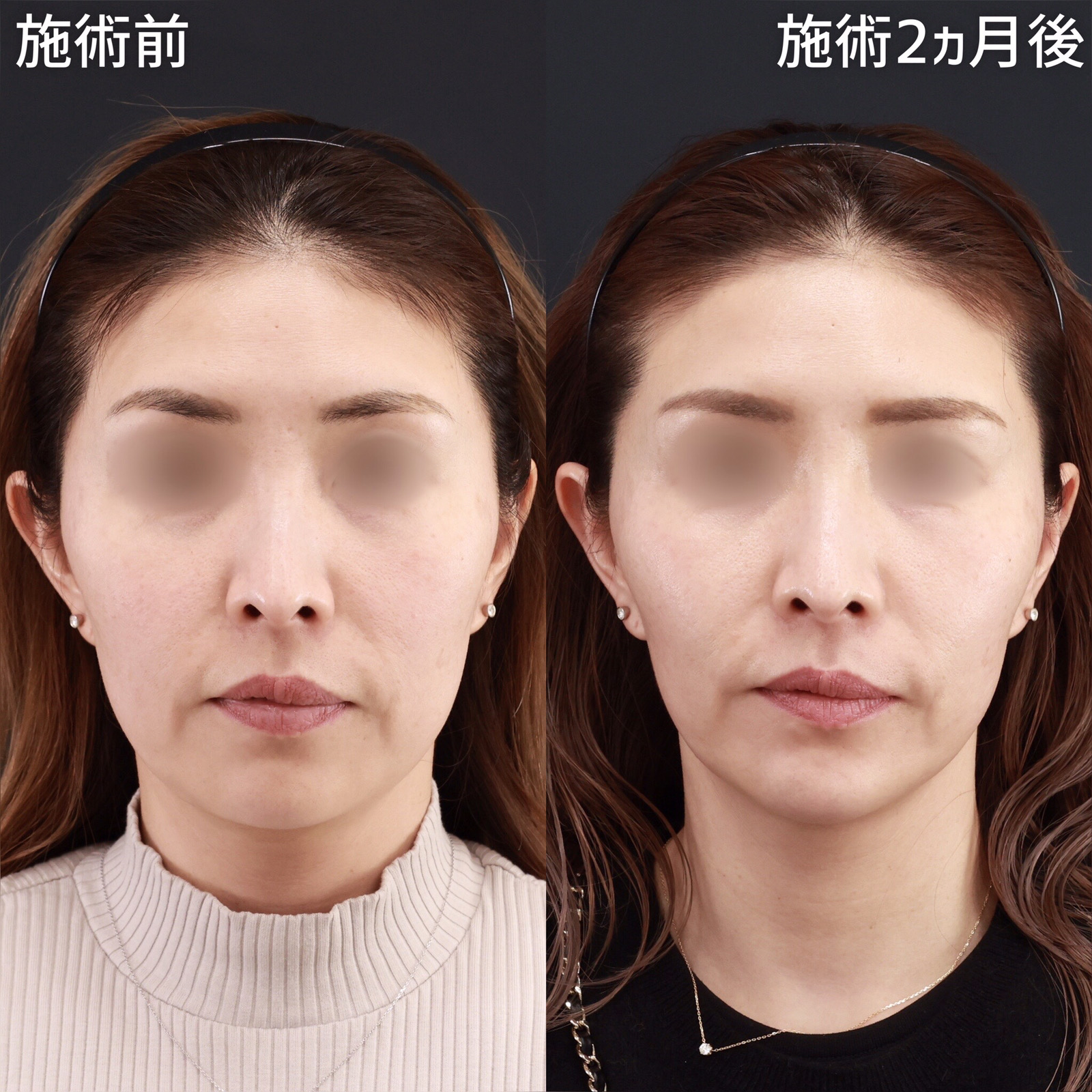 【パーフェクトフェイスライン】ダウンタイムが取れない方はライトがおすすめ！