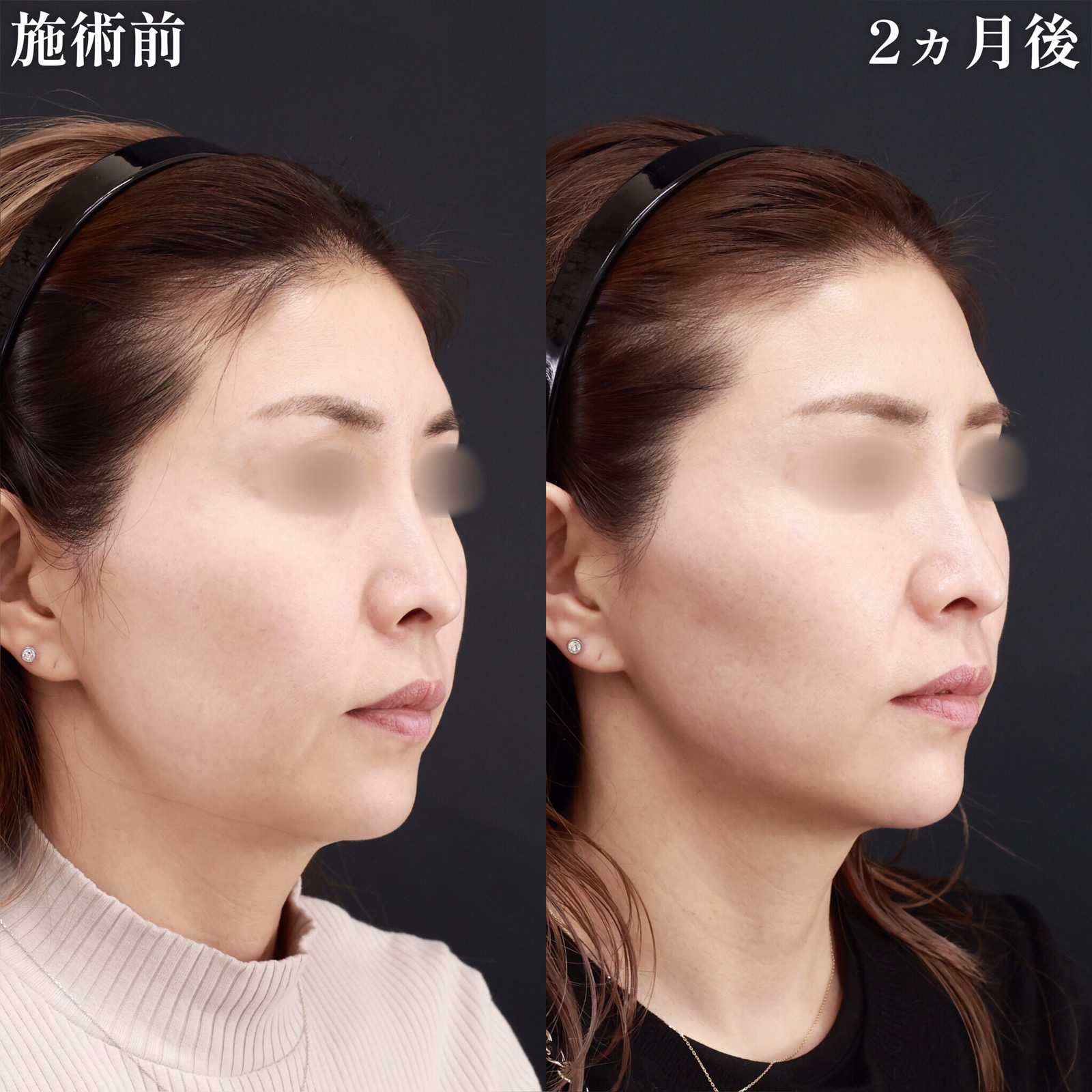 小顔整形｜パーフェクトフェイスライン/脂肪溶解注射/TAC式 ツヤ肌コラーゲンリフト®の症例写真 施術前後 