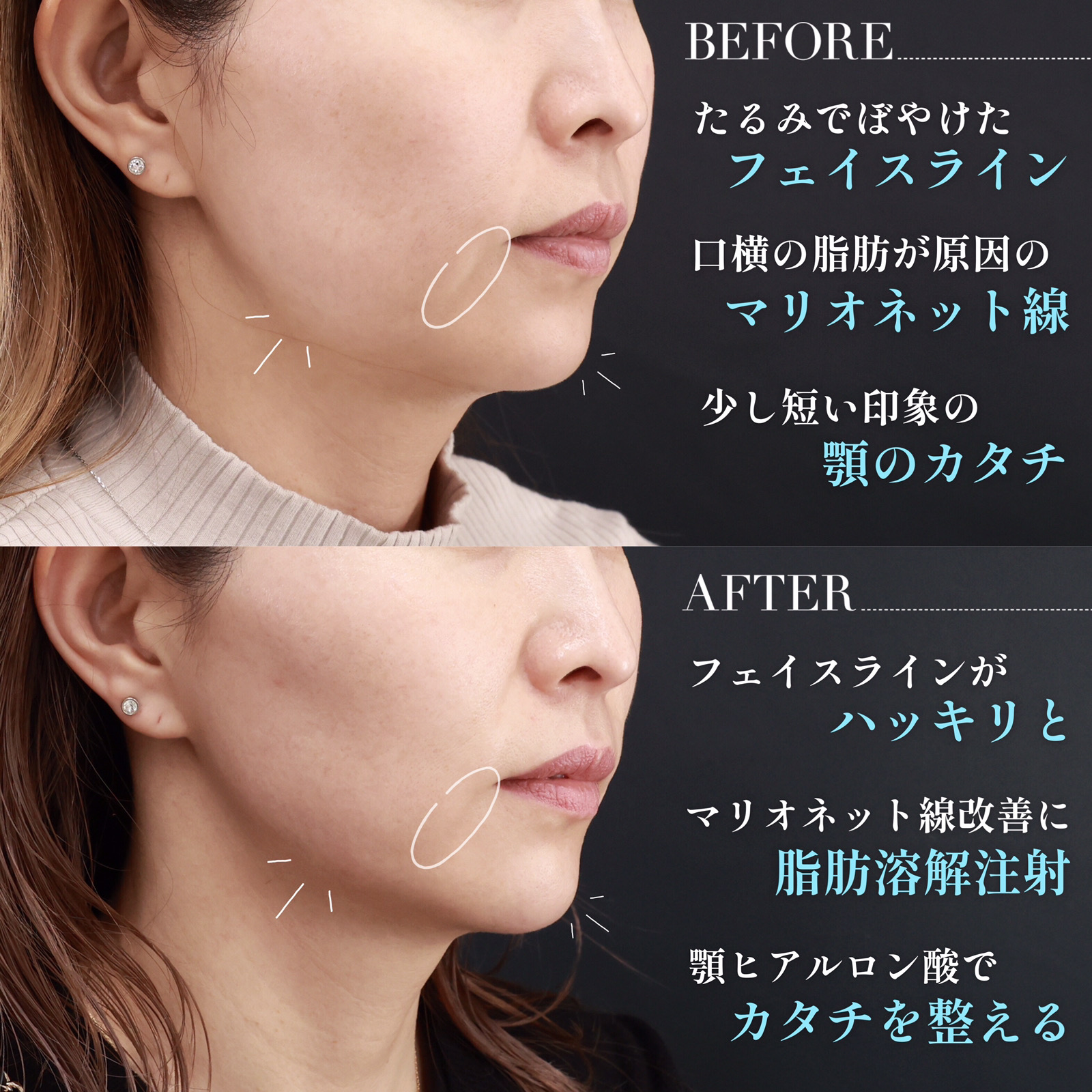 小顔整形｜パーフェクトフェイスライン/脂肪溶解注射/TAC式 ツヤ肌コラーゲンリフト®の症例写真 施術前後 