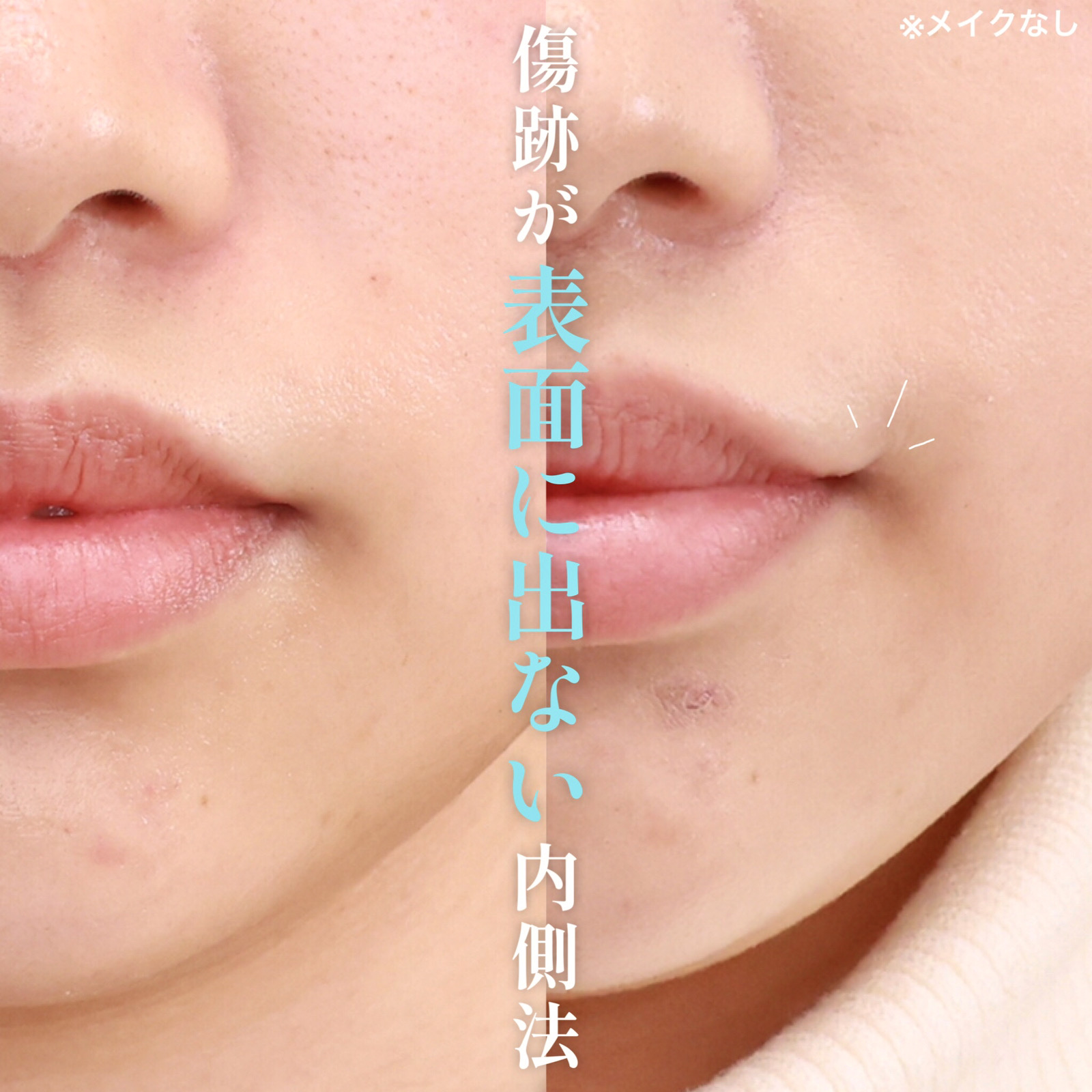 口角挙上・リフト（マイクロ切開法・内側法/口内法）の症例写真 施術前後 