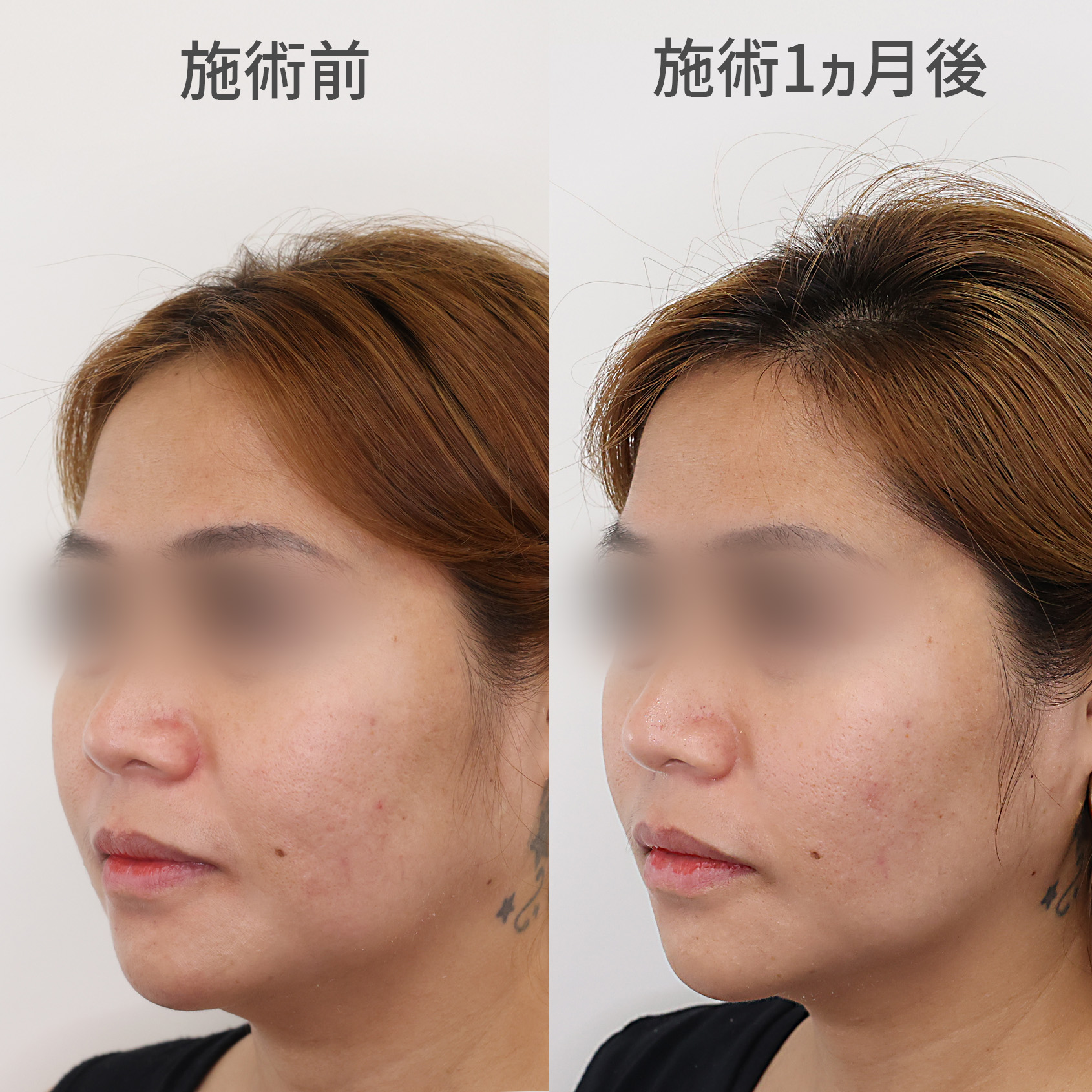 バッカルファット除去の症例写真 施術前後 