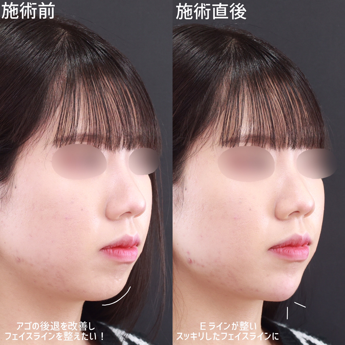 顎のヒアルロン酸注射/エラボトックス注射の症例写真 施術前後