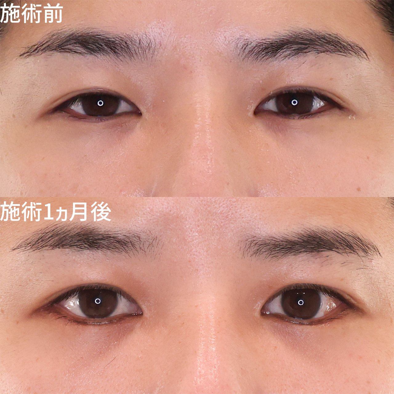 目尻切開術/グラマラスライン(タレ目形成)の症例写真 施術前後