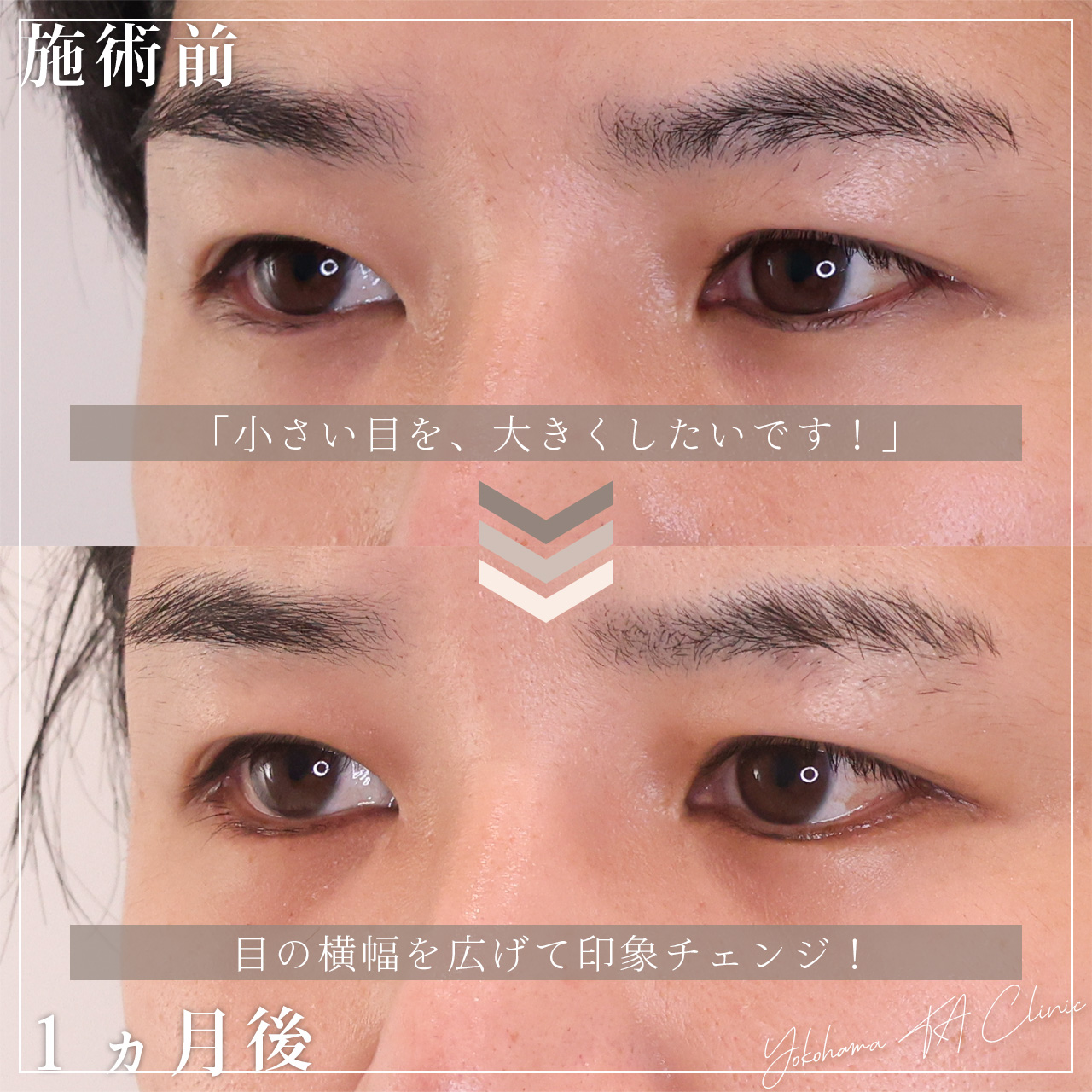 目尻切開術/グラマラスライン(タレ目形成)の症例写真 施術前後