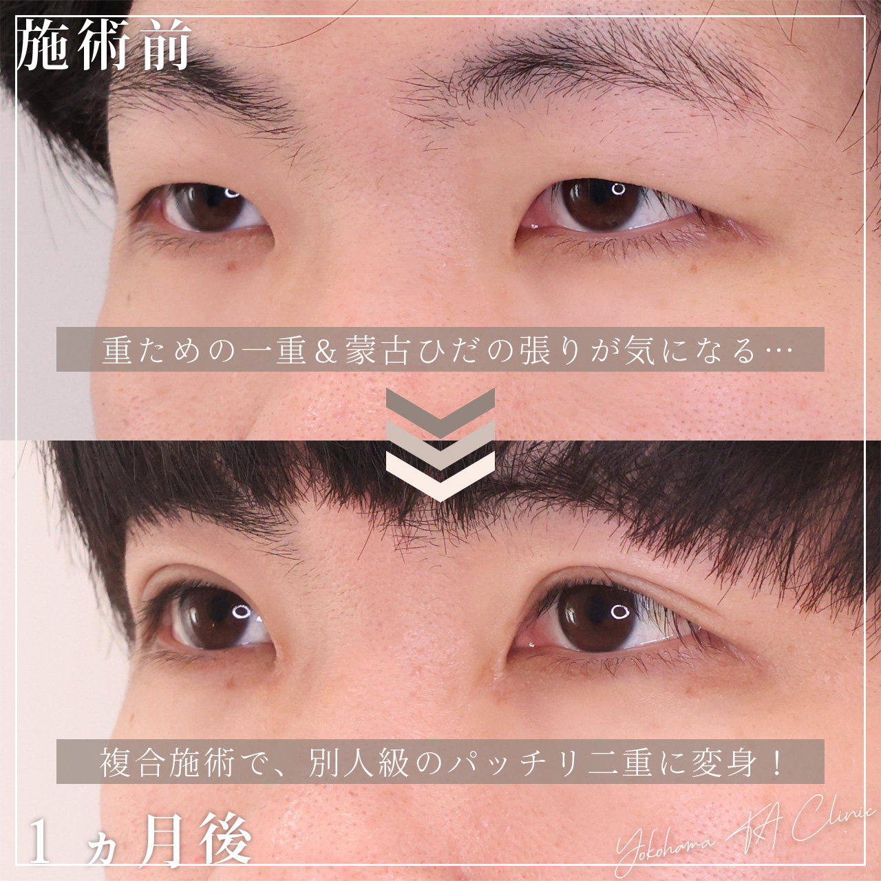 二重埋没法/目頭切開術の症例写真 施術前後 