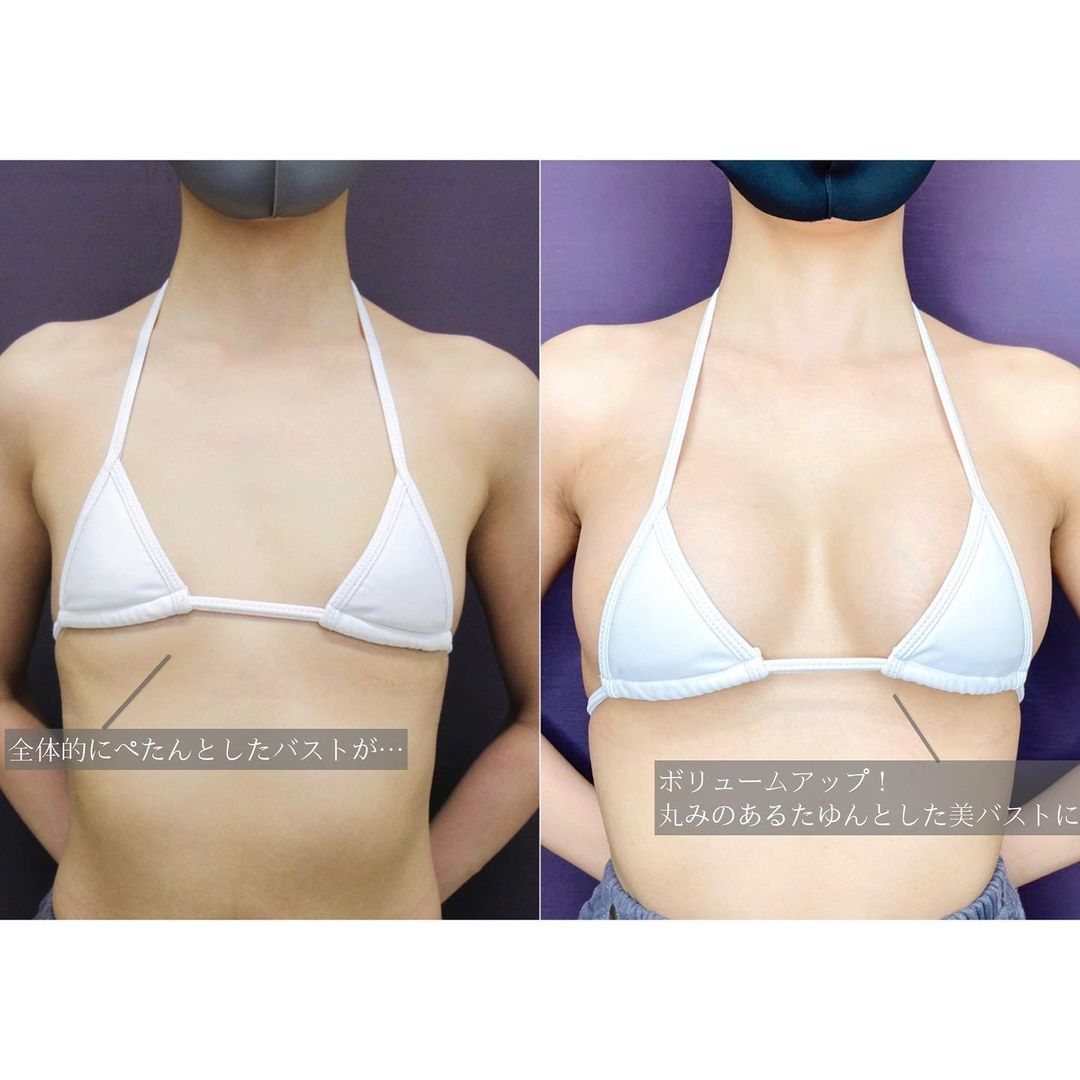 シリコンバッグ豊胸（人工乳腺バッグ）の症例写真 施術前後 