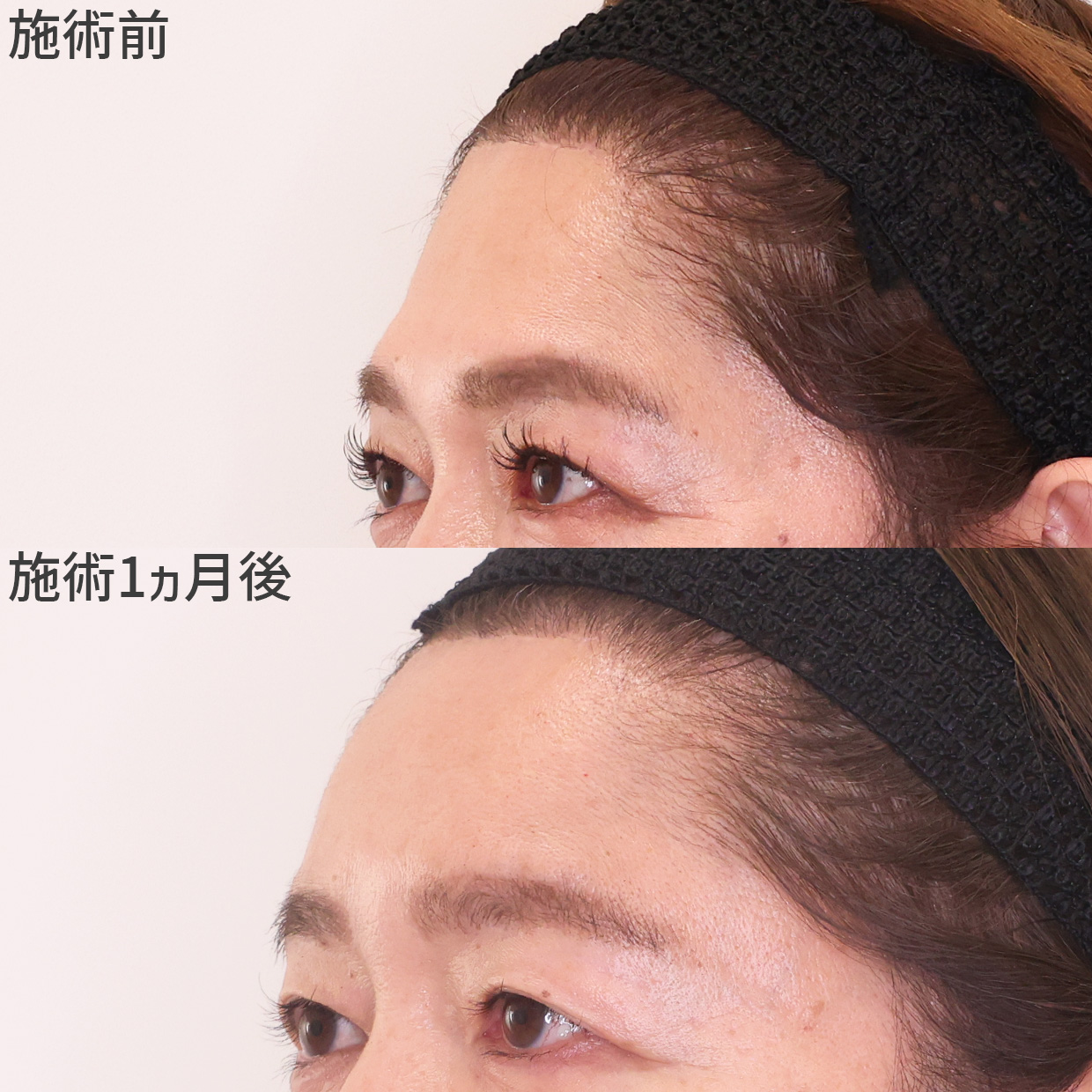 内側カーブで凹んで見えるおでこを改善！若々しい印象に