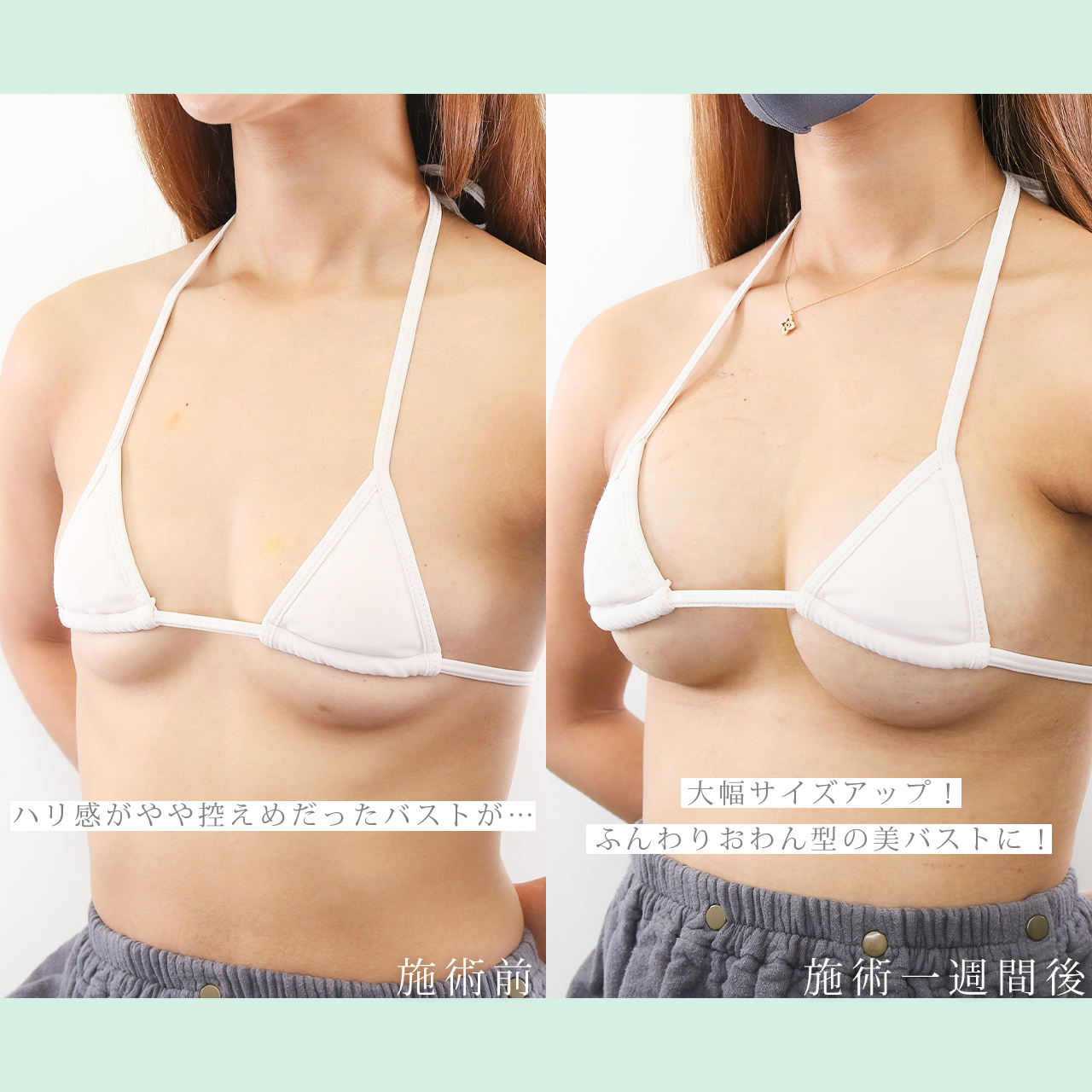 シリコンバッグ豊胸（人工乳腺バッグ）の症例写真 施術前後 