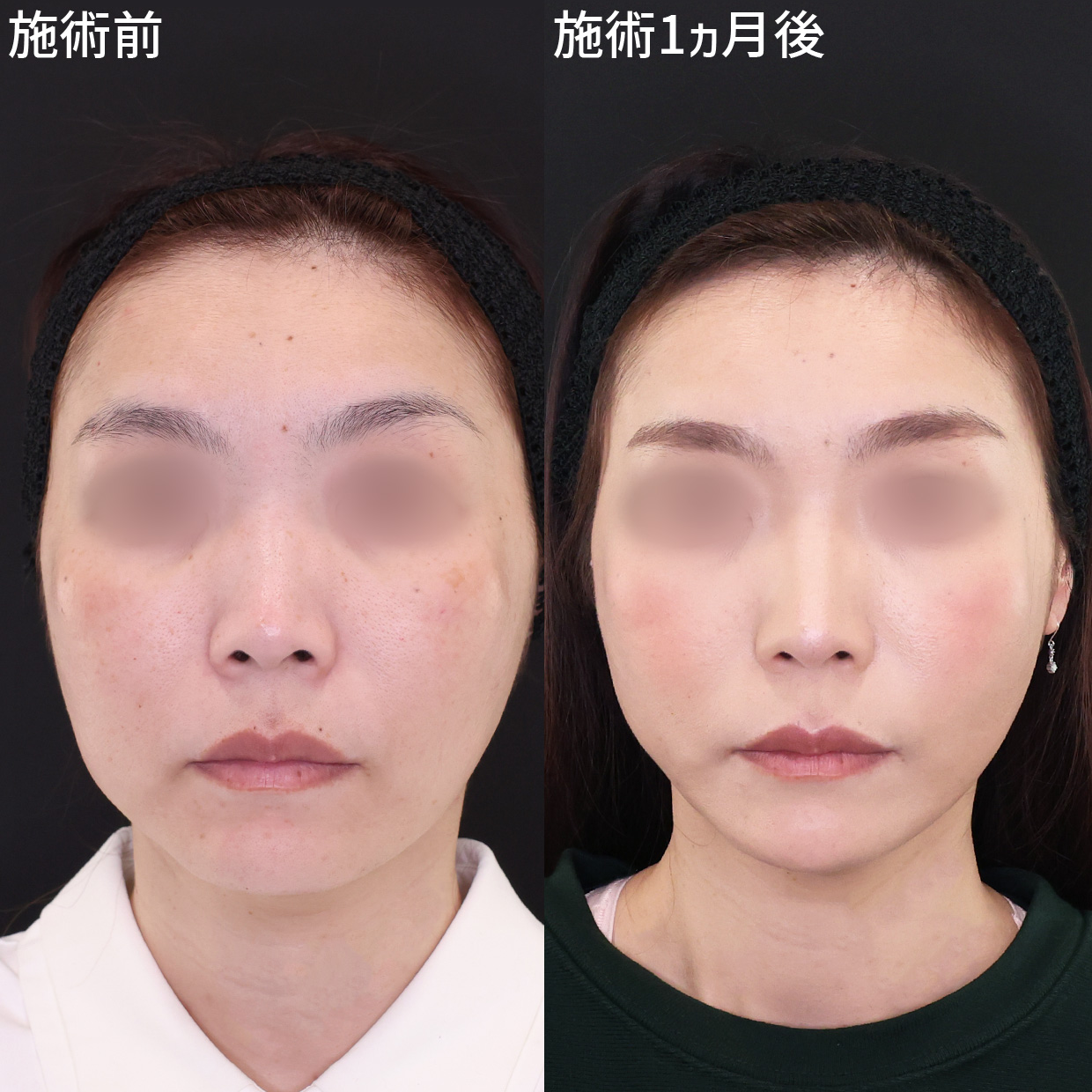 加齢と共に気になる輪郭のたるみ… 効果を実感できる「ツヤ肌コラーゲンリフト®極」