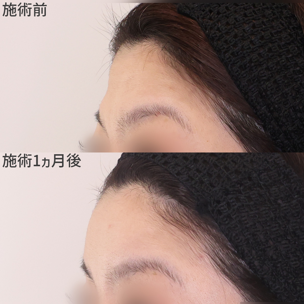 内側に反って見える額を丸みのある形に【脂肪注入術】