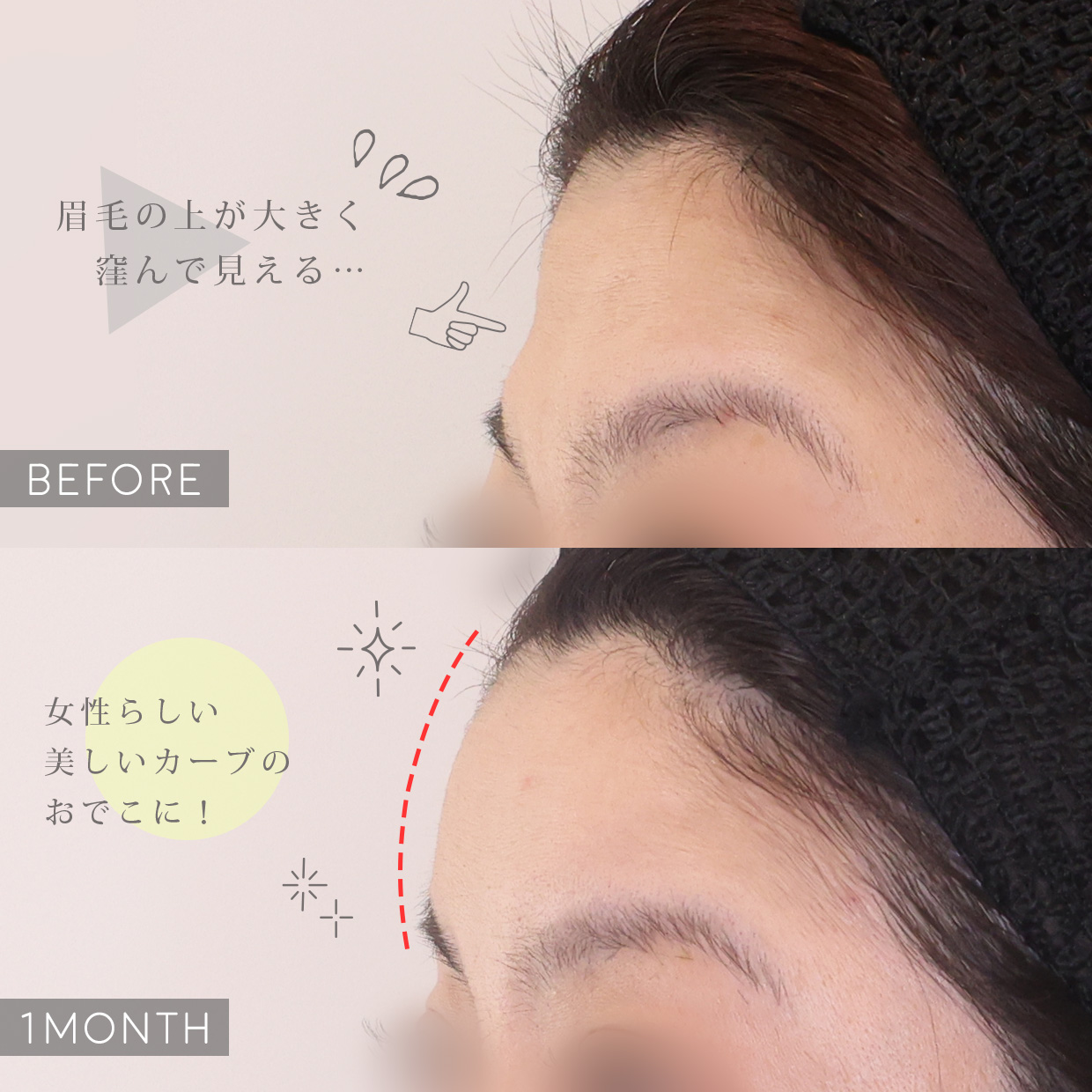 おでこの脂肪注入（オルチャンデコ形成）の症例写真 施術前後 