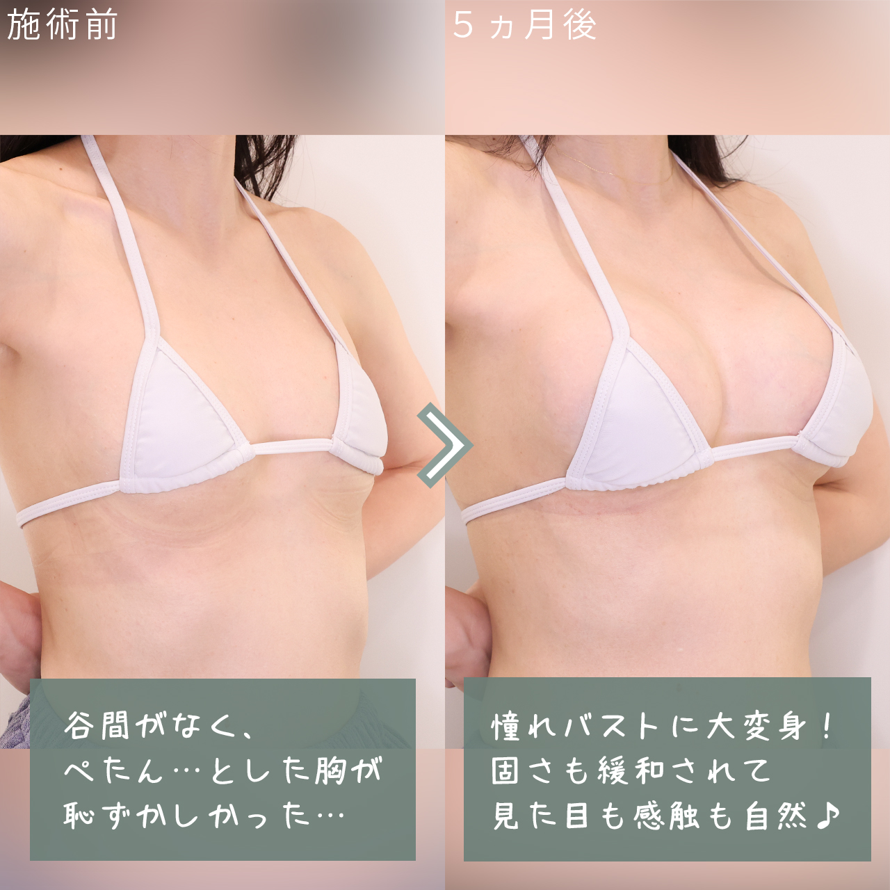 シリコンバッグ豊胸（人工乳腺バッグ）の症例写真 施術前後 