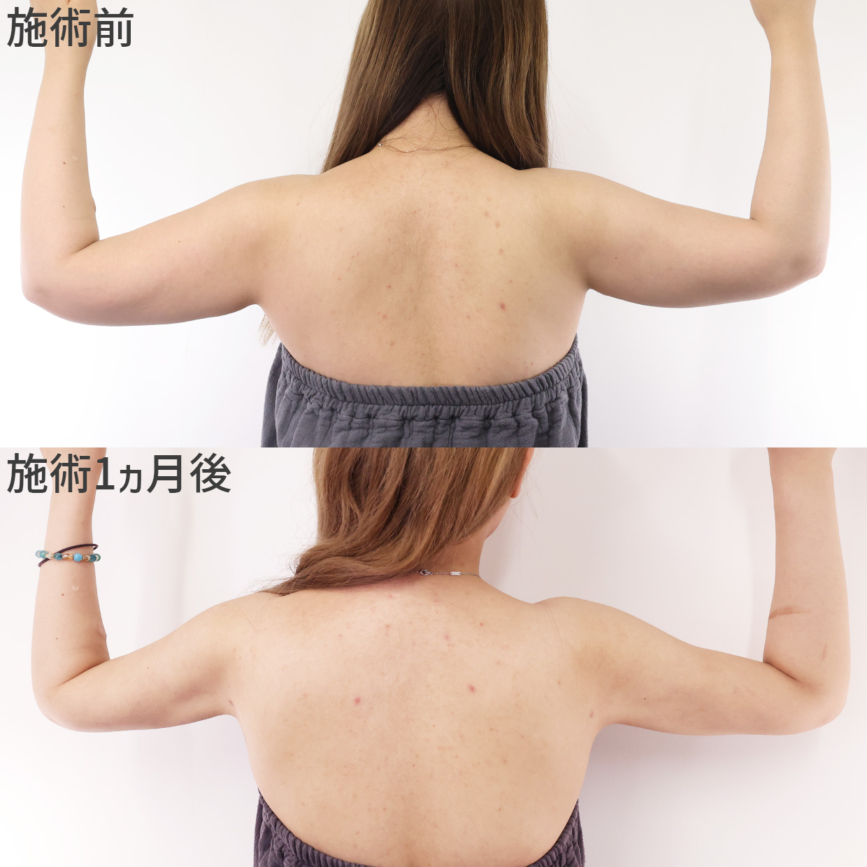 体の脂肪吸引の症例写真 施術前後 