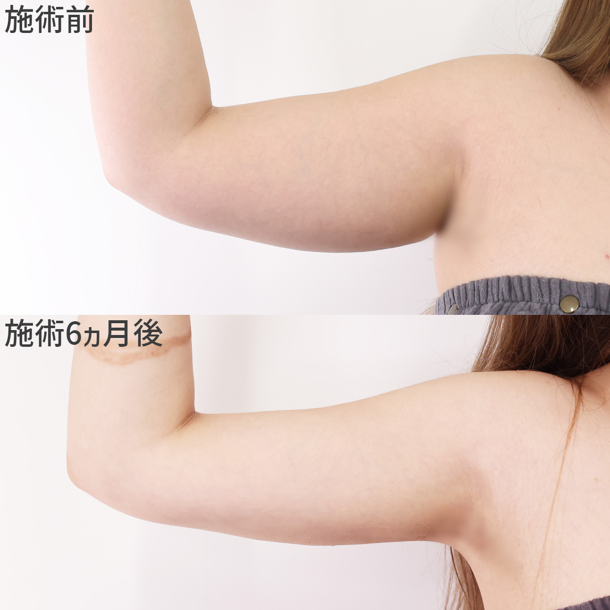 二の腕、太もも…気になる部位を細く！脂肪吸引でほっそり痩せ