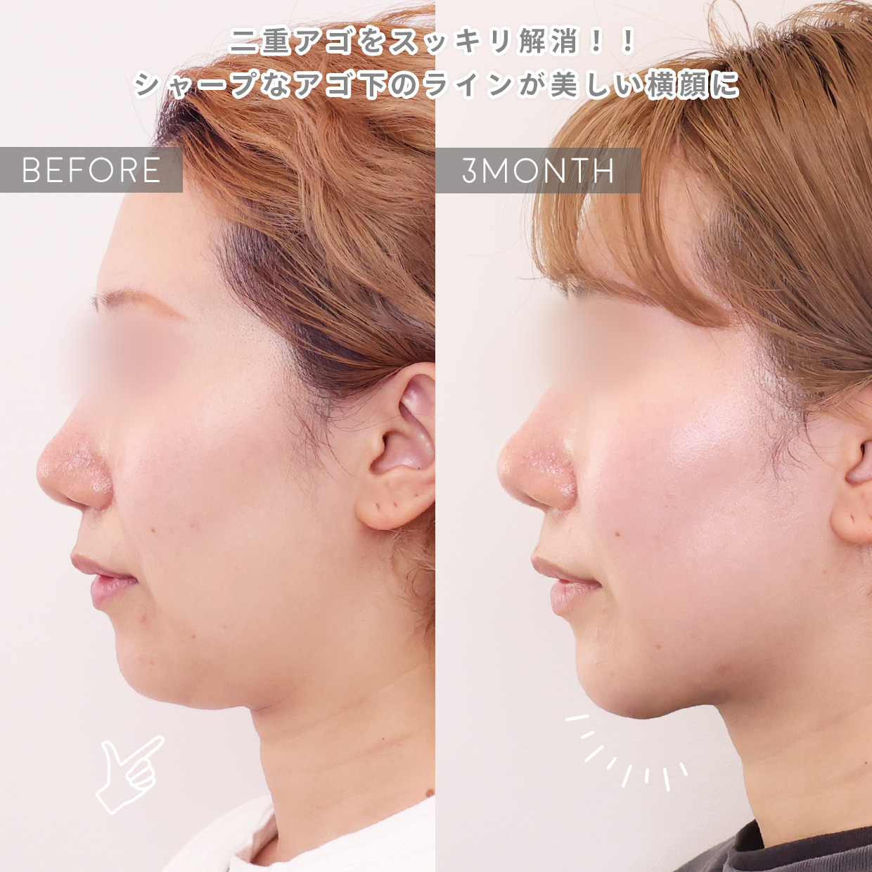 TAC式 ツヤ肌コラーゲンリフト®/顔の脂肪吸引の症例写真 施術前後 