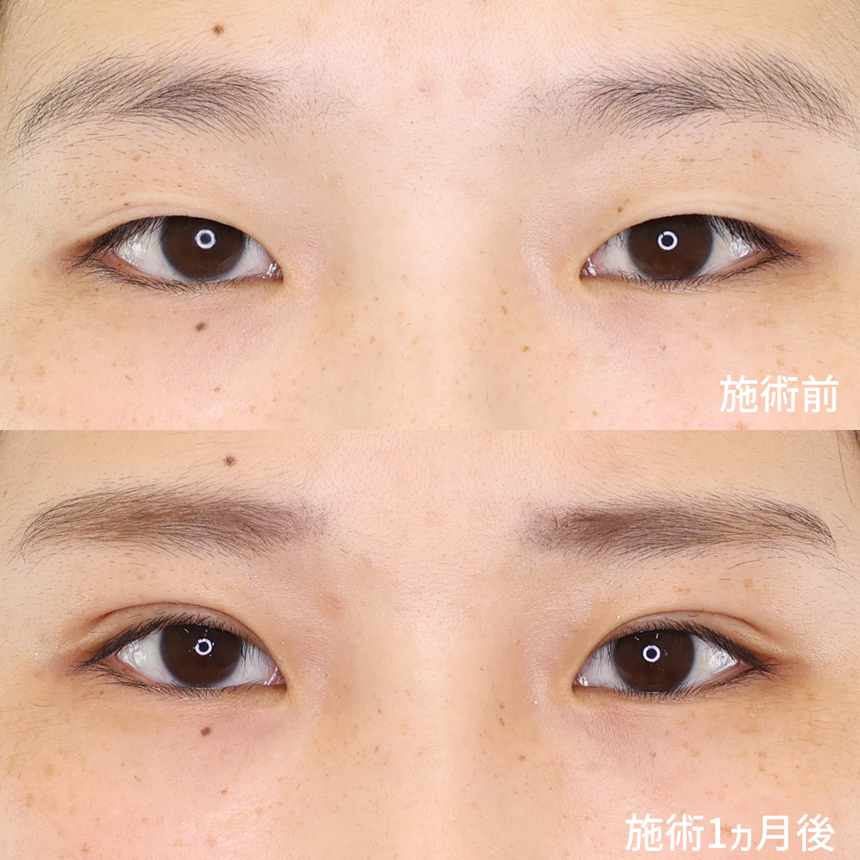 強くて腫れない埋没法【TAC式グランドリンク（特殊埋没法）】