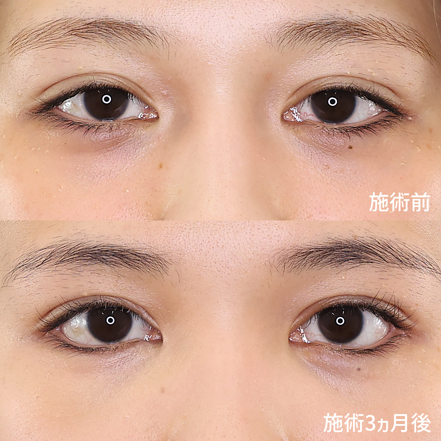 メリハリのある圧倒的に若々しい印象の目元に！　【目尻切開】【クマ取り】【タレ目形成】の症例を解説。