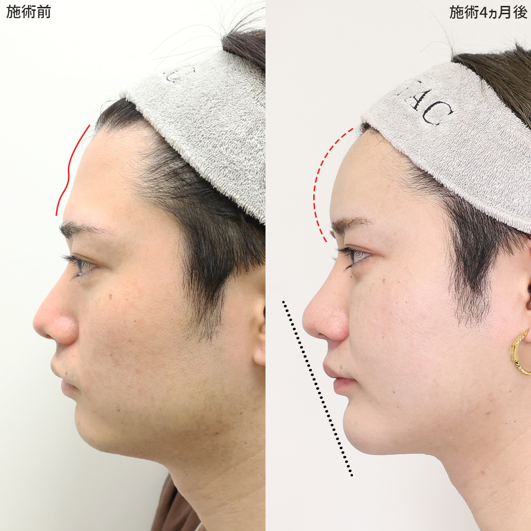 TAC式 ツヤ肌コラーゲンリフト®/顔の脂肪吸引/下眼瞼脱脂術（目の下のたるみ取り・目の下の脂肪ふくらみ取り）の症例写真 施術前後 