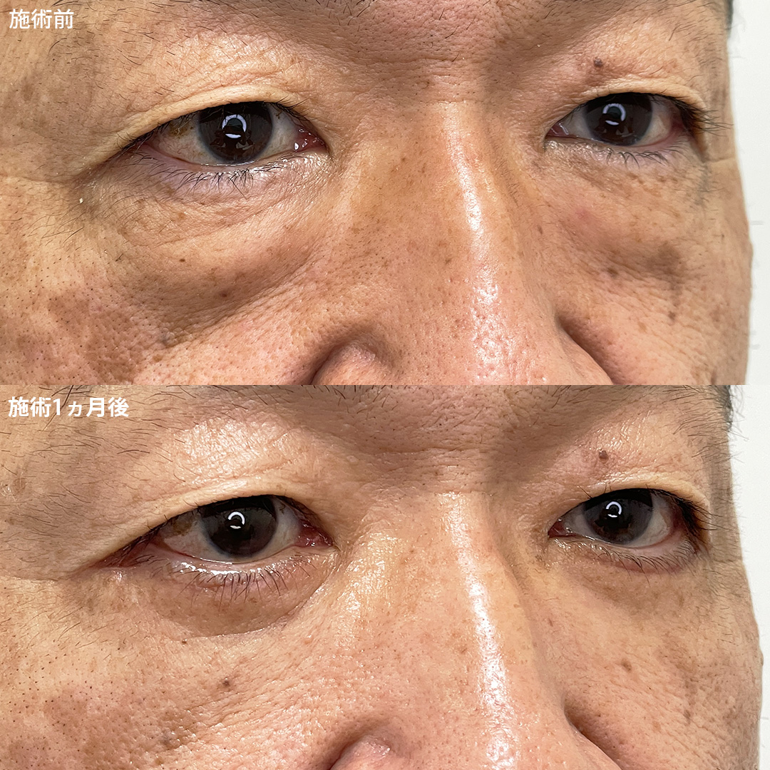 【目の下のクマ】でお悩みの方は必見です