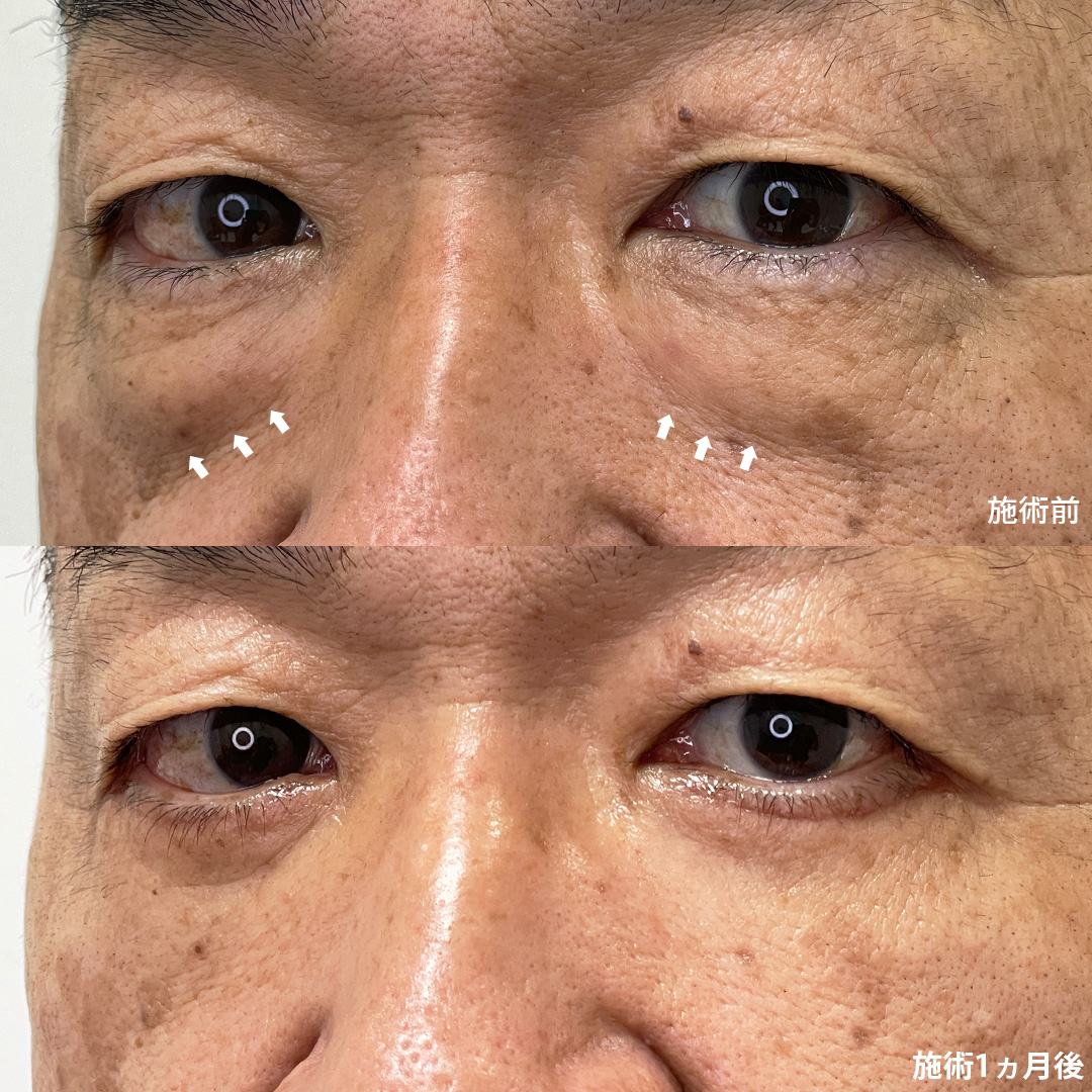 下眼瞼脱脂術（目の下のたるみ取り・目の下の脂肪ふくらみ取り）/下眼瞼切開術（クマ・たるみとり）の症例写真 施術前後 