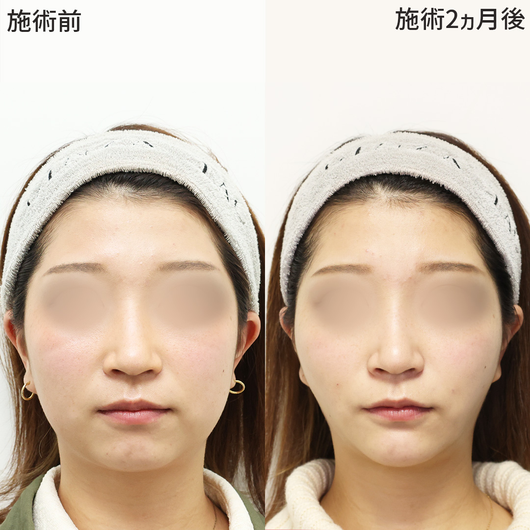 小顔整形|パーフェクトフェイスライン/TAC式 ツヤ肌コラーゲンリフト®/バッカルファット除去の症例写真 施術前後