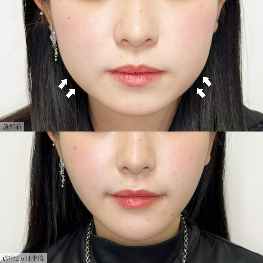 TAC式 ツヤ肌コラーゲンリフト®/バッカルファット除去/ジョールファット除去の症例写真 施術前後