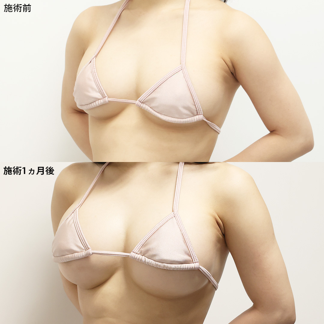 シリコンバッグ豊胸（人工乳腺バッグ）の症例写真 施術前後 