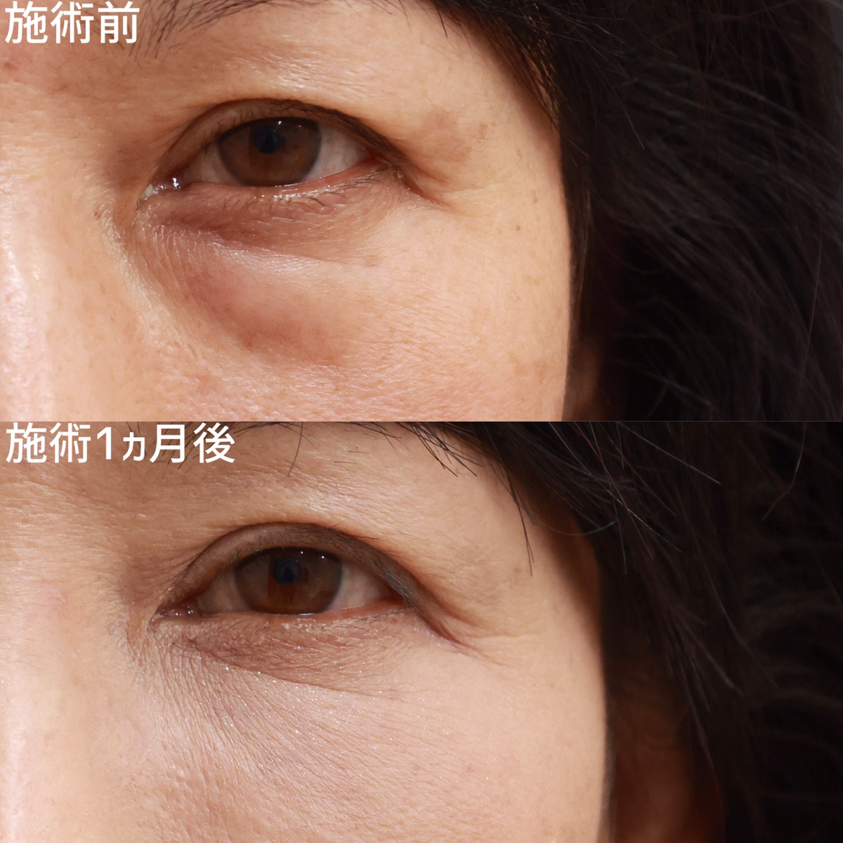 下眼瞼脱脂術(目の下のたるみ取り・目の下の脂肪ふくらみ取り)/顔の脂肪注入(コンデンスリッチフェイス)の症例写真 施術前後