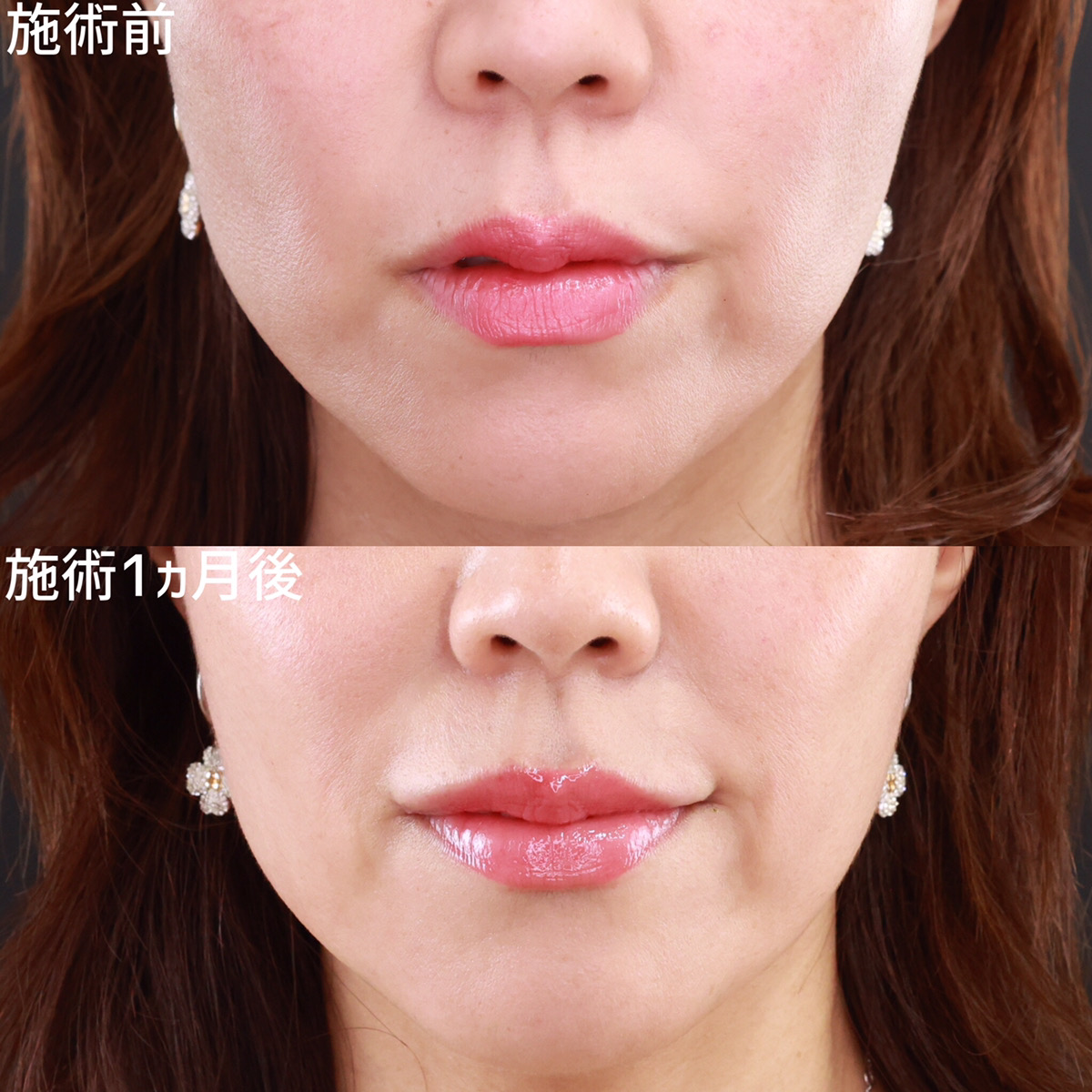 口角リフトで優しく可愛らしい口元