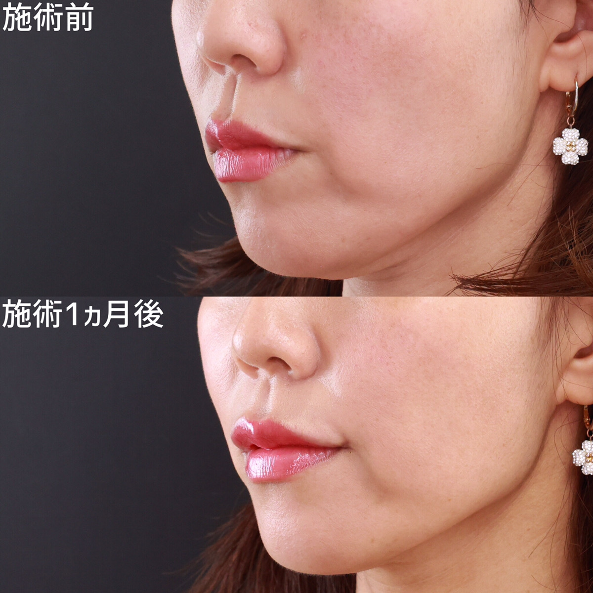 口角挙上・リフト（マイクロ切開法・内側法/口内法）/ヒアルロン酸注射：その他の症例写真 施術前後 