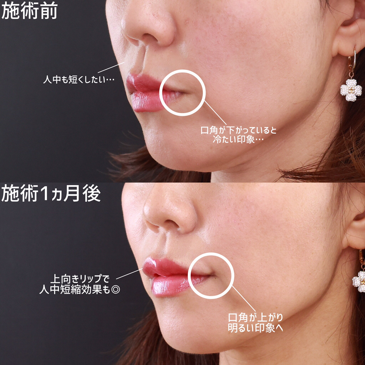 口角挙上・リフト（マイクロ切開法・内側法/口内法）/ヒアルロン酸注射：その他の症例写真 施術前後 