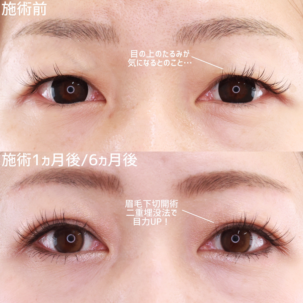 二重埋没法/眉毛下切開術の症例写真 施術前後 