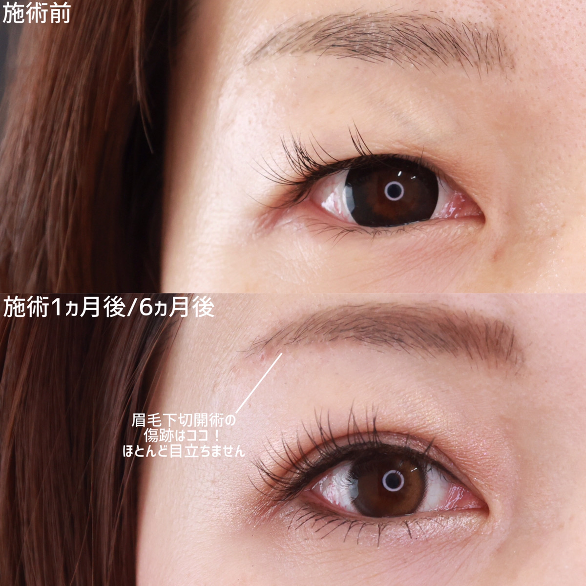 二重埋没法/眉毛下切開術の症例写真 施術前後 