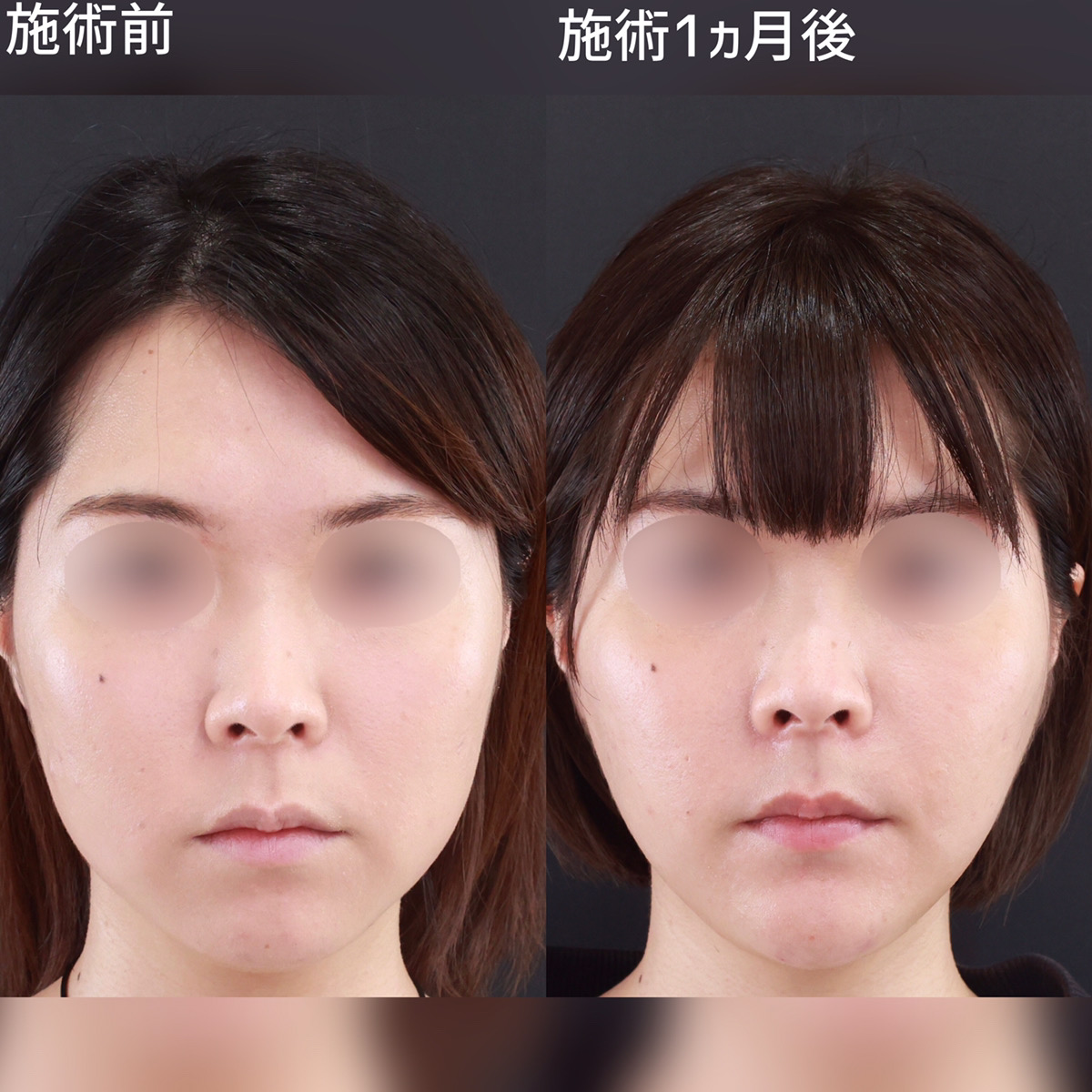 小顔整形|パーフェクトフェイスライン/TAC式 ツヤ肌コラーゲンリフト®/ジョールファット除去の症例写真 施術前後