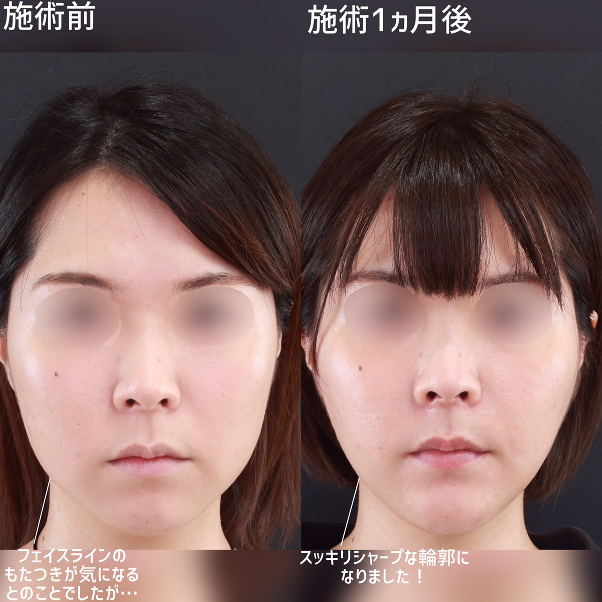小顔整形|パーフェクトフェイスライン/TAC式 ツヤ肌コラーゲンリフト®/ジョールファット除去の症例写真 施術前後