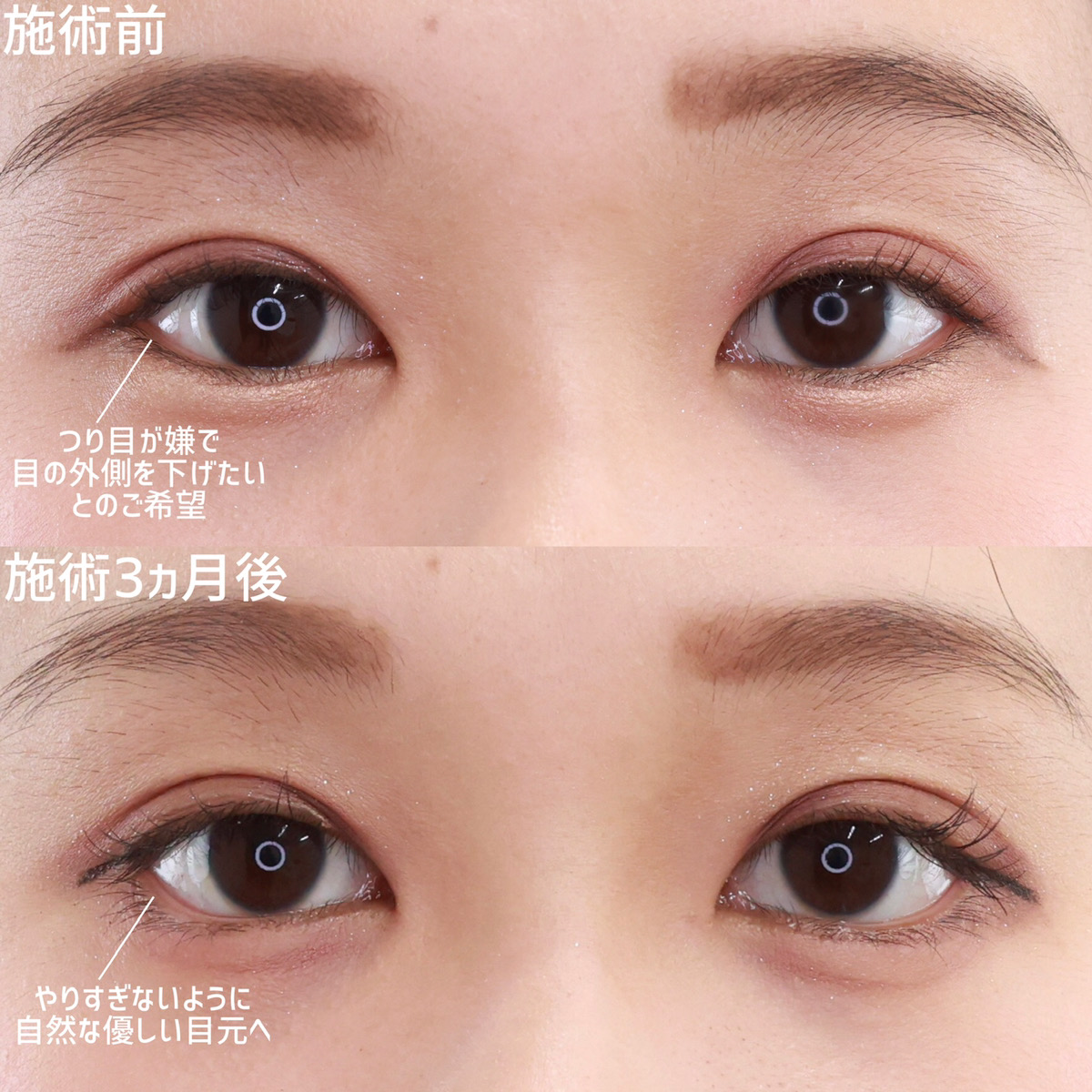 グラマラスライン(タレ目形成)の症例写真 施術前後