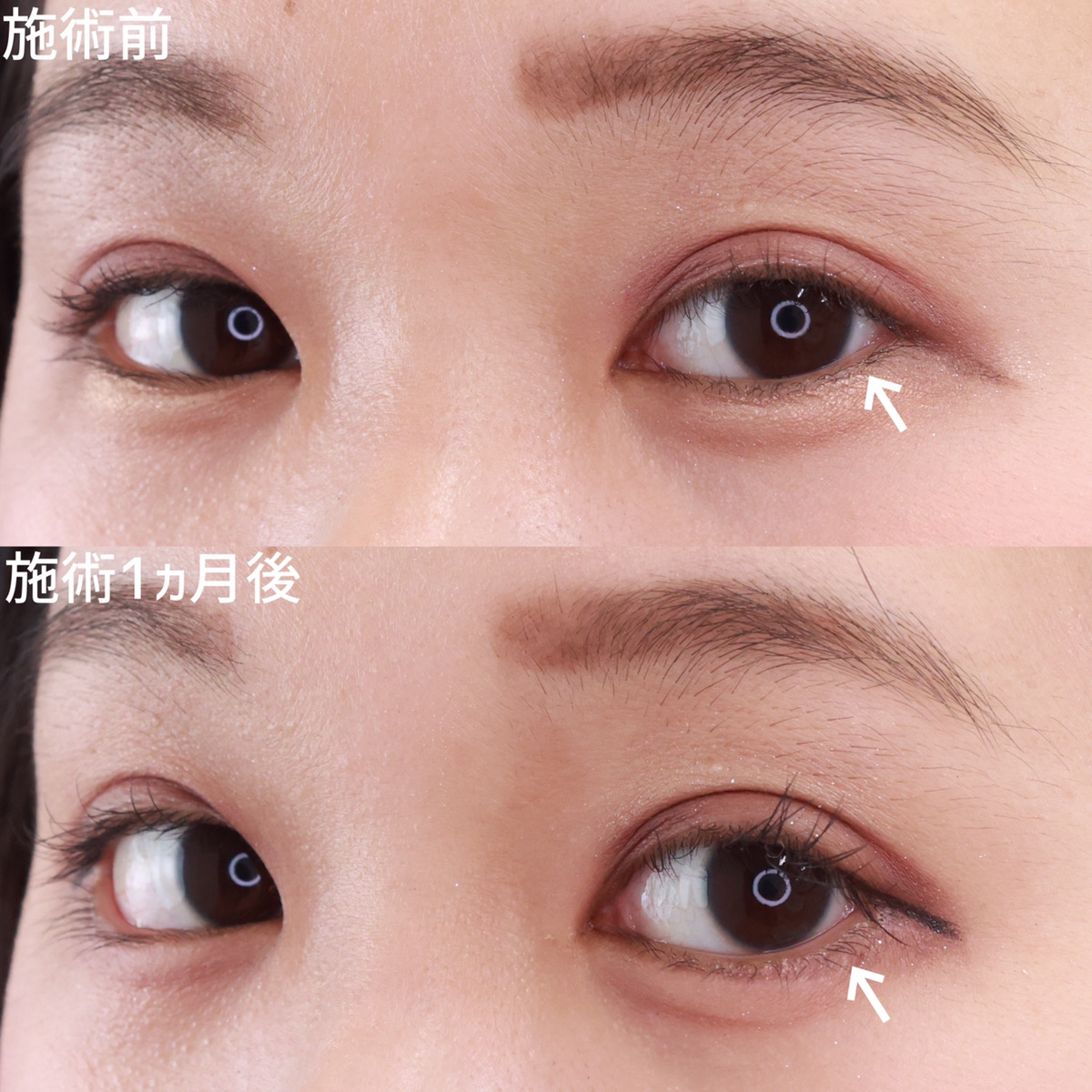 グラマラスライン(タレ目形成)の症例写真 施術前後