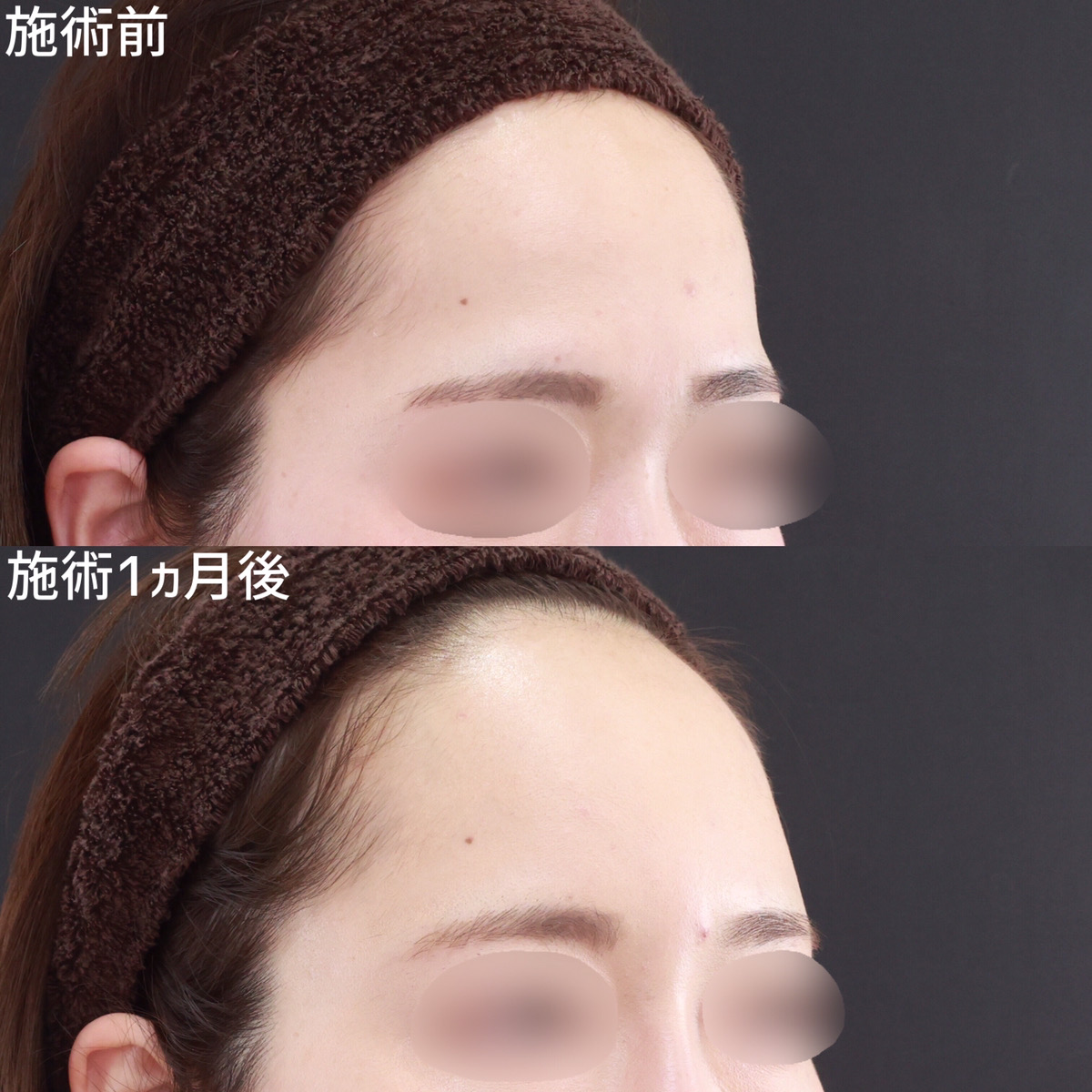 くぼみ改善！自然で綺麗なオルチャンデコ！