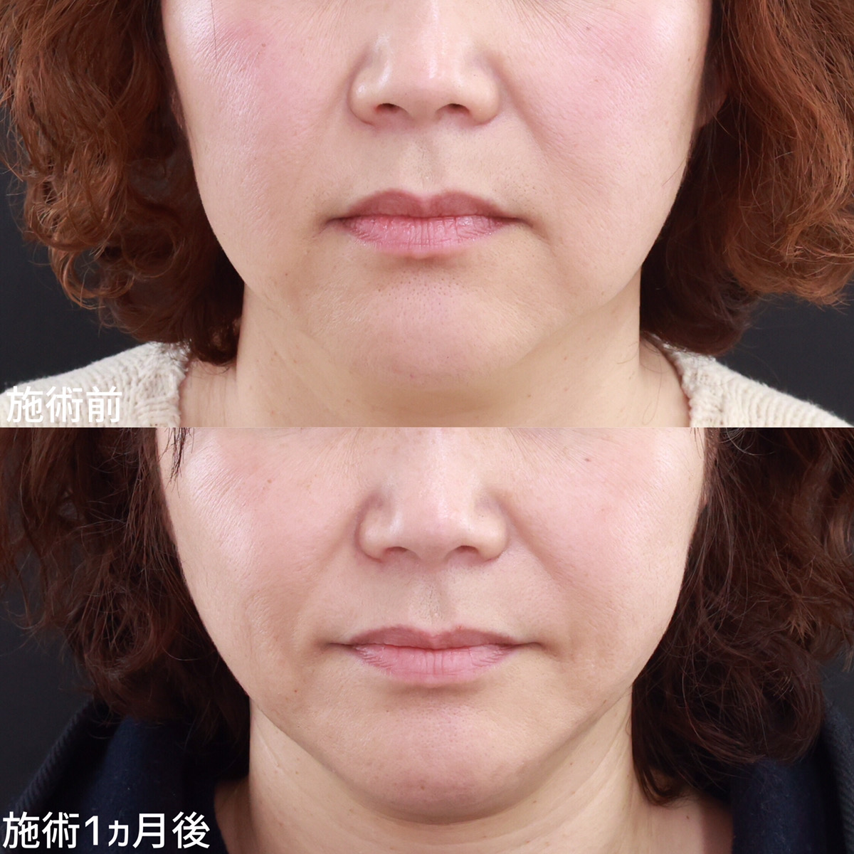 糸リフト＋脂肪除去でマリオネットライン撃退！シャープな輪郭で若々しい印象