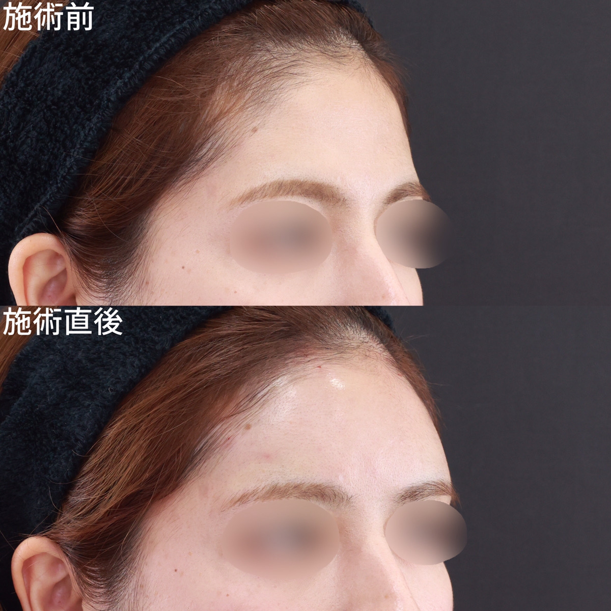 ダウンタイムも少なく、直後から変化が分かるヒアルロン酸注射でオルチャンデコ