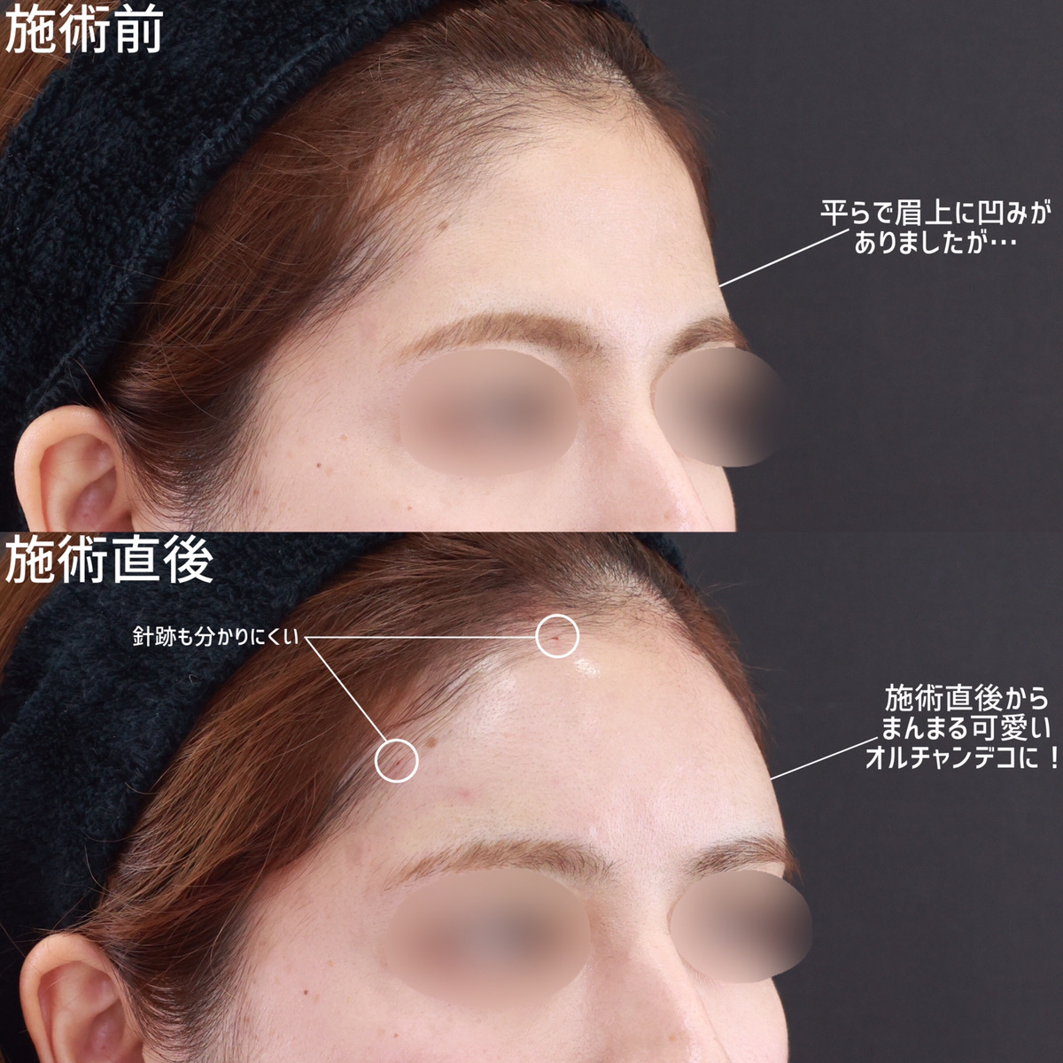 おでこ・こめかみのヒアルロン酸注射の症例写真 施術前後 