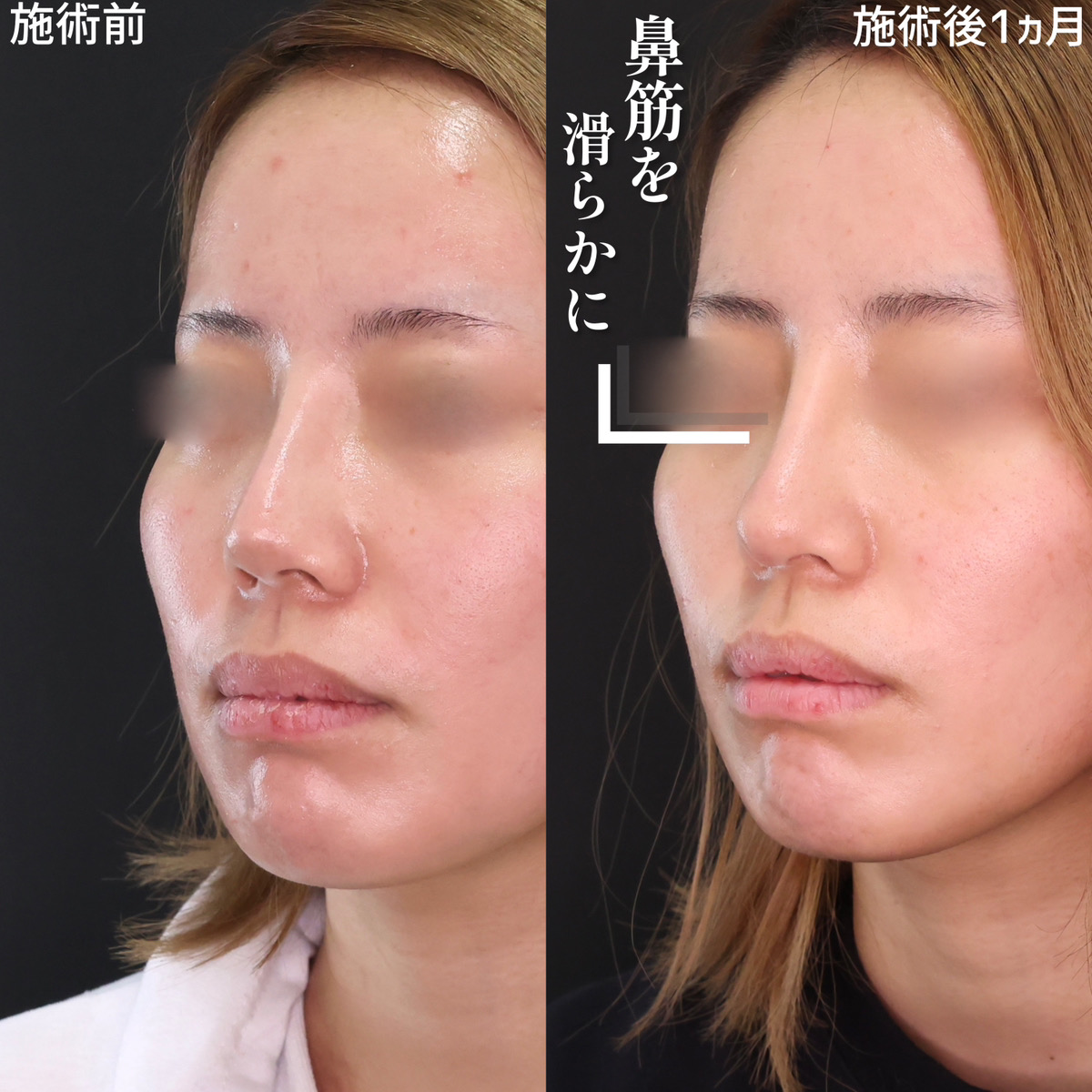 隆鼻術（プロテーゼ・自家組織）/鼻尖形成・鼻尖縮小/鼻先軟骨移植の症例写真 施術前後 