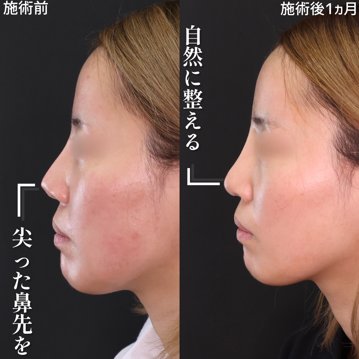 隆鼻術（プロテーゼ・自家組織）/鼻尖形成・鼻尖縮小/鼻先軟骨移植の症例写真 施術前後 