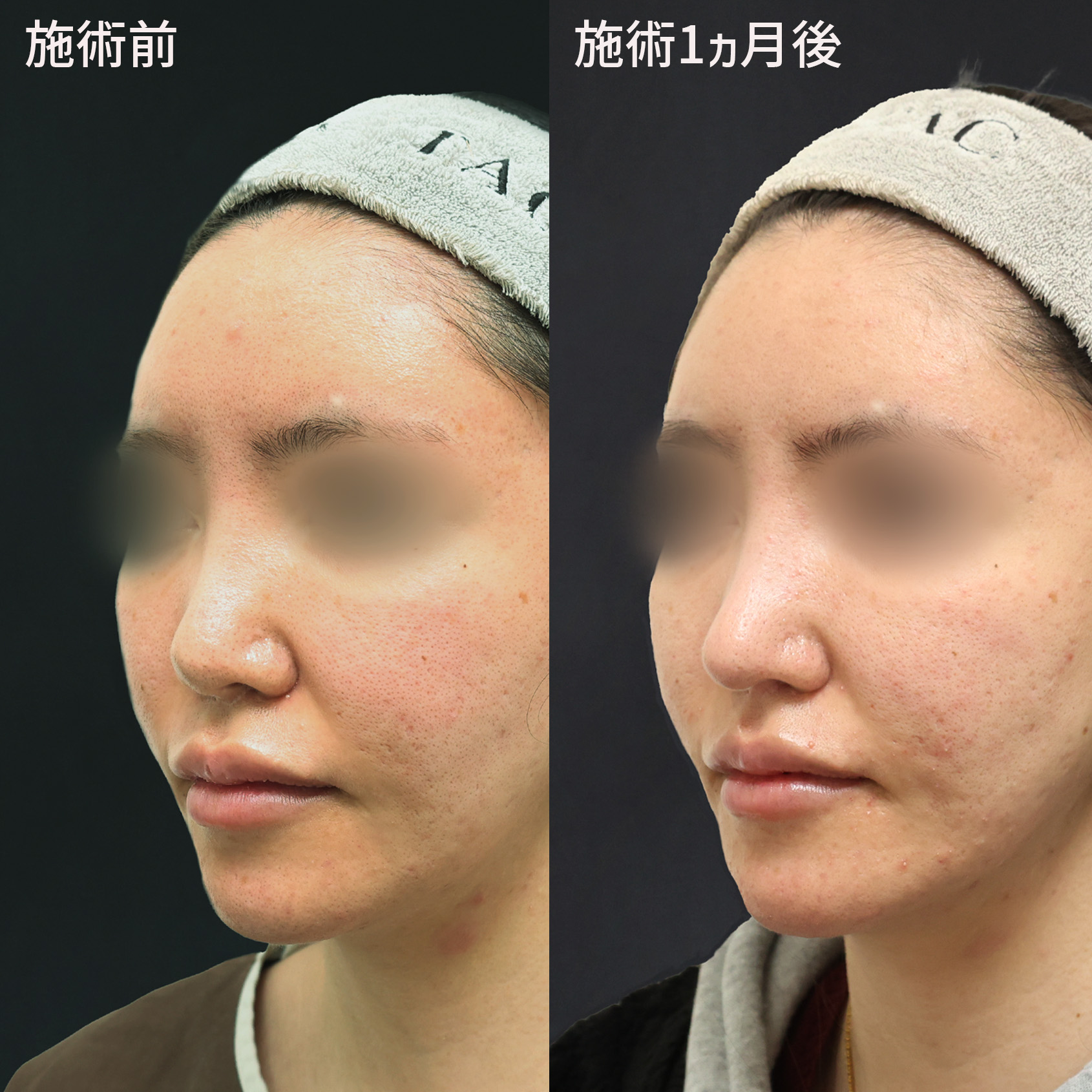 他院でうけた鼻整形に満足できなかった方の理想が叶った！TAクリニックの修正オペ！！