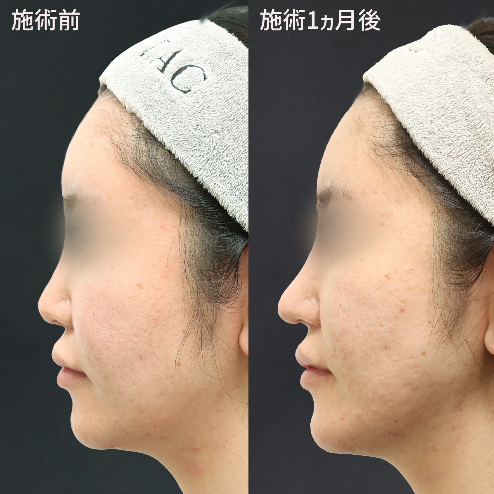 鼻中隔延長術/鼻先軟骨移植/隆鼻術（プロテーゼ・自家組織）の症例写真 施術前後 