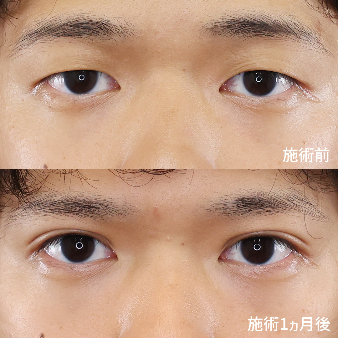 自然な パッチリ二重で満足度◎！TAクリニックの二重埋没法！！