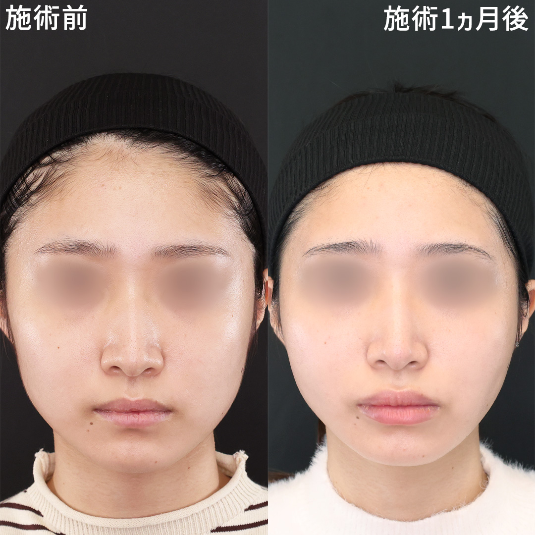 コンプレックス改善を一緒に考える《小顔施術》