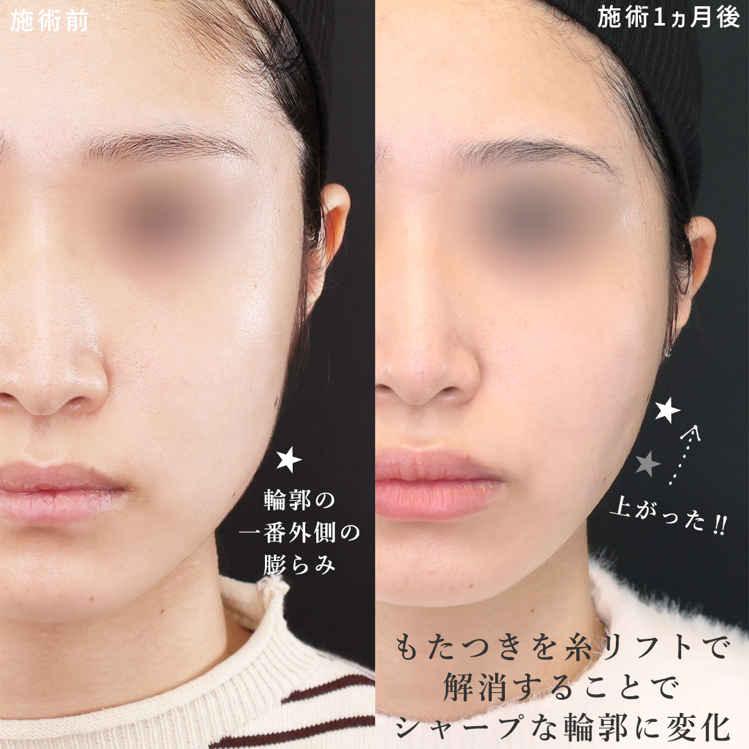 TAC式 ツヤ肌コラーゲンリフト®/ヒアルロン酸注射：その他/エラボトックス注射の症例写真 施術前後 