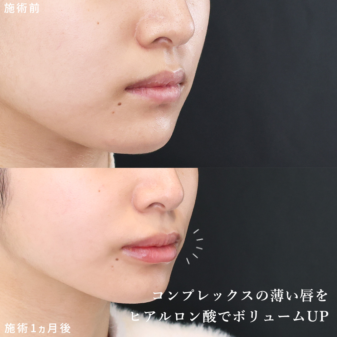 TAC式 ツヤ肌コラーゲンリフト®/ヒアルロン酸注射：その他/エラボトックス注射の症例写真 施術前後 